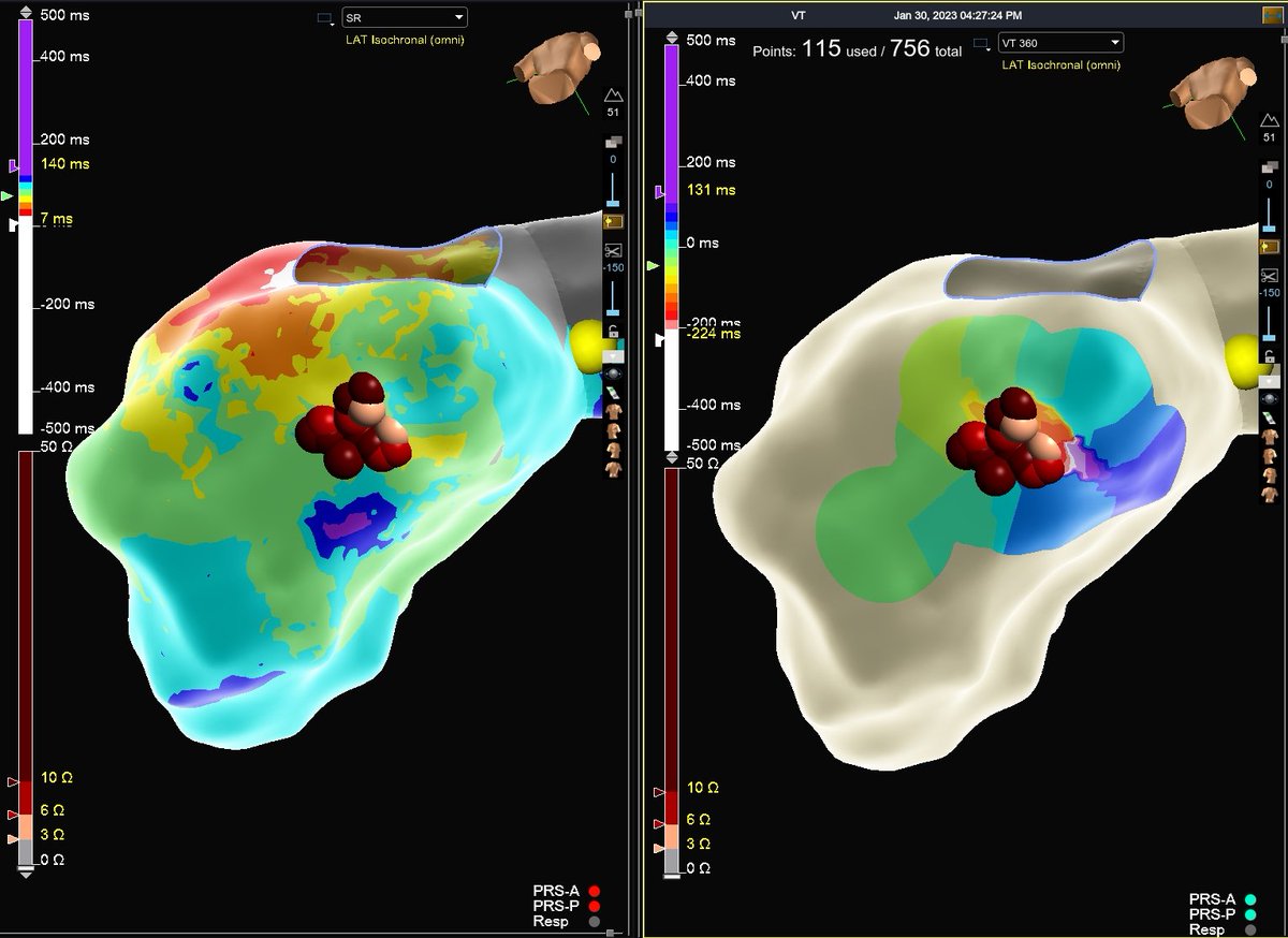 Hapa_EP's tweet image. What could have been a lengthy homogenization of a massive inferior scar now becomes just a handful of burns in a small, but critical zone for VT. #mapmoreburnless