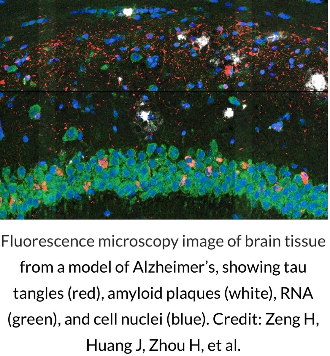 enilev's tweet image. Brain Cell Changes in #Alzheimer’s Disease Mapped @MIT 
👉neurosciencenews.com/alzheimers-bra…

#AD #STARmapPlus #Neurotech #MWC23 

@JBarbosaPR @IanLJones98 @psb_dc @SpirosMargaris @BetaMoroney @bimedotcom @mvollmer1 @PawlowskiMario @tobiaskintzel @CurieuxExplorer @RLDI_Lamy @jeancayeux