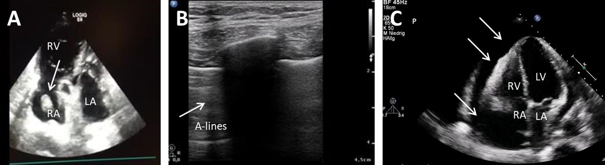 RCMjournal's tweet photo. #RCM-Special Issue: Cardiogenic Shock (4/5)
🧩Obstructive Shock, from Diagnosis to Treatment
@VivianeZotzmann @TobiWengenmayer
#ObstructiveShock #Shock #cardiac
Full Text:
https://t.co/AQeaTrVZ1n https://t.co/O7Svv1cCFZ