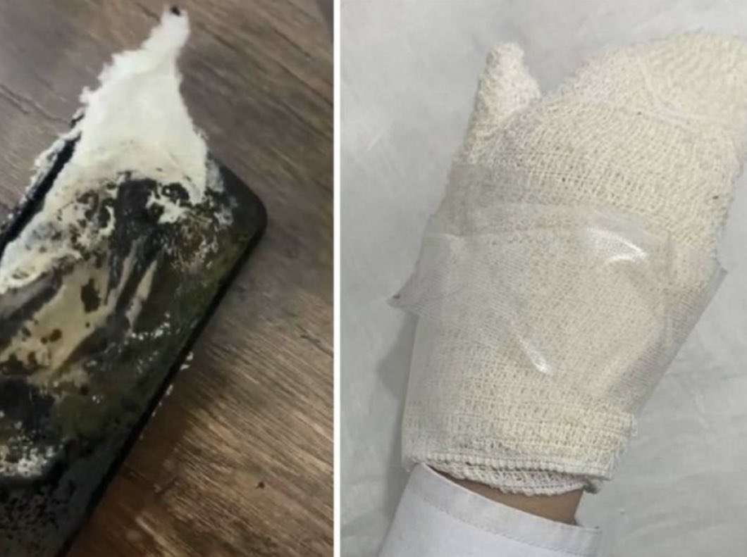 احتراق جوال في يد فتاة بعد نومها وتركه موصول بالشاحن .. ياساتر انتبهوا 😮