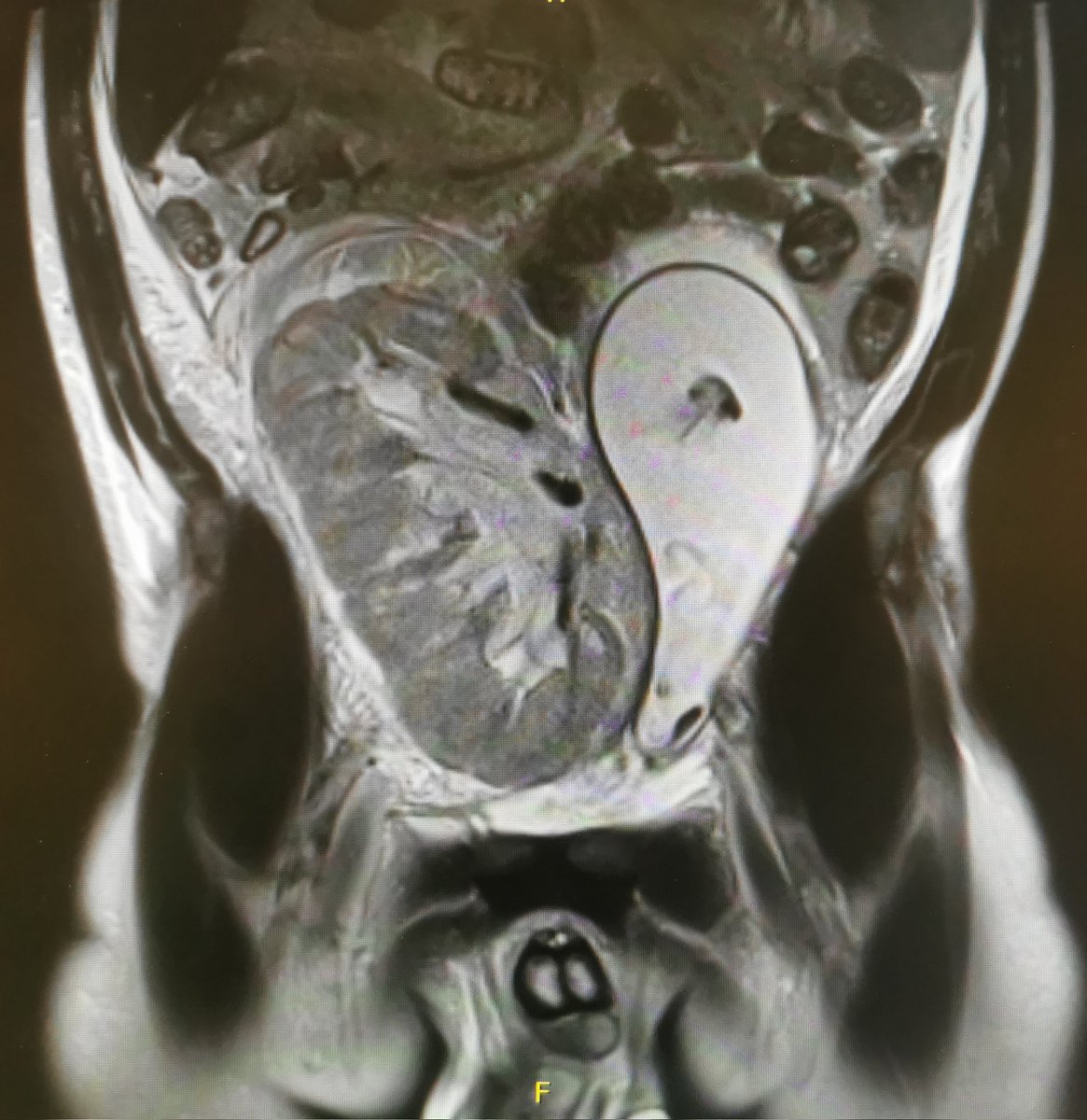 _LucaCigagna_'s tweet photo. Another #day
Another #kidney
Another #transplant https://t.co/gSwxhxcXfJ