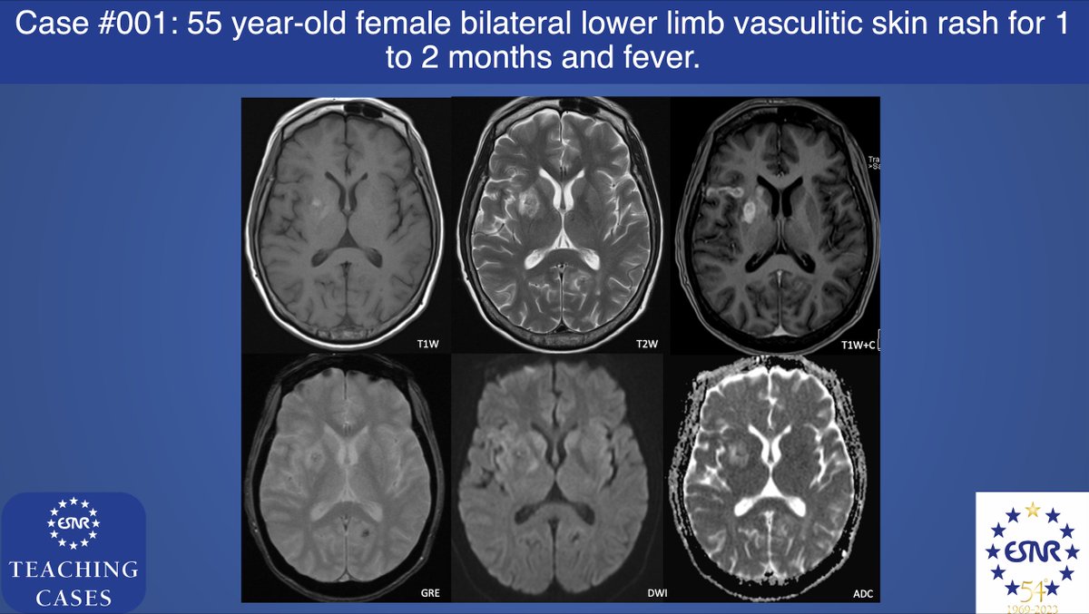 ESNRad's tweet photo. #ESNRTC case 1: 55 year-old female with good past health
•Bilateral lower limb vasculitic skin rash for 1- to 2- months
•Fever, malaise and weight loss
•white cell count (14.0 x 109/L), raised erythrocyte sedimentation rate (107mm/hr) https://t.co/1agnmWAgh6