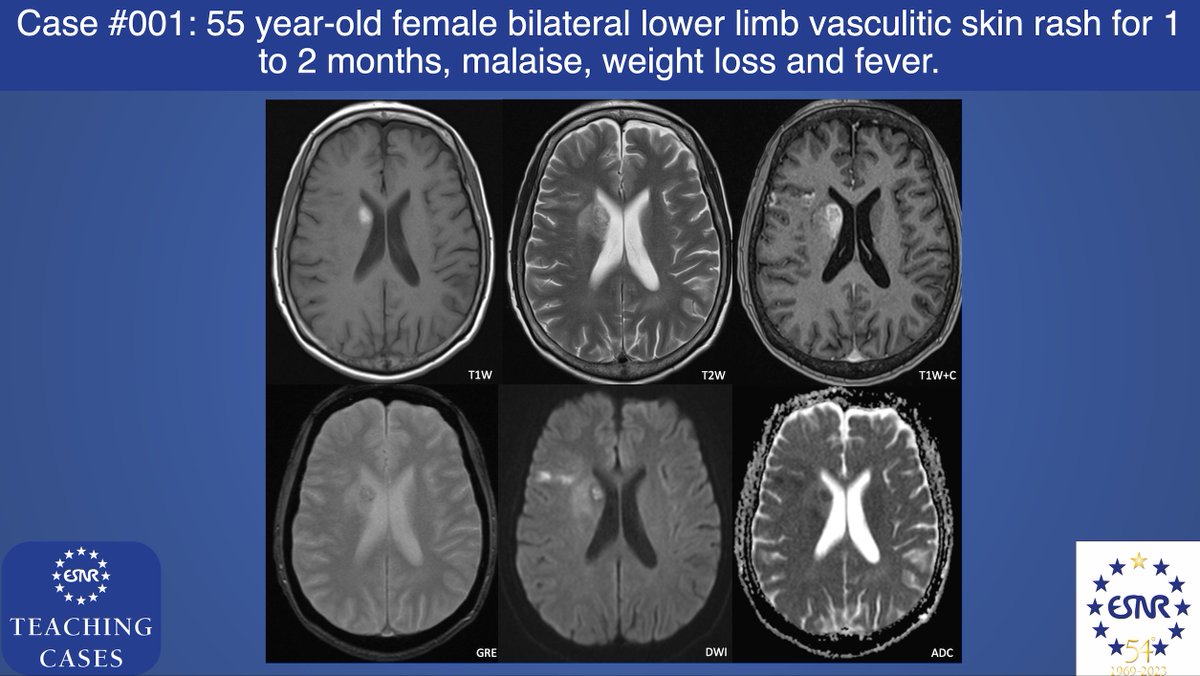 ESNRad's tweet photo. #ESNRTC case 1: 55 year-old female with good past health
•Bilateral lower limb vasculitic skin rash for 1- to 2- months
•Fever, malaise and weight loss
•white cell count (14.0 x 109/L), raised erythrocyte sedimentation rate (107mm/hr) https://t.co/1agnmWAgh6