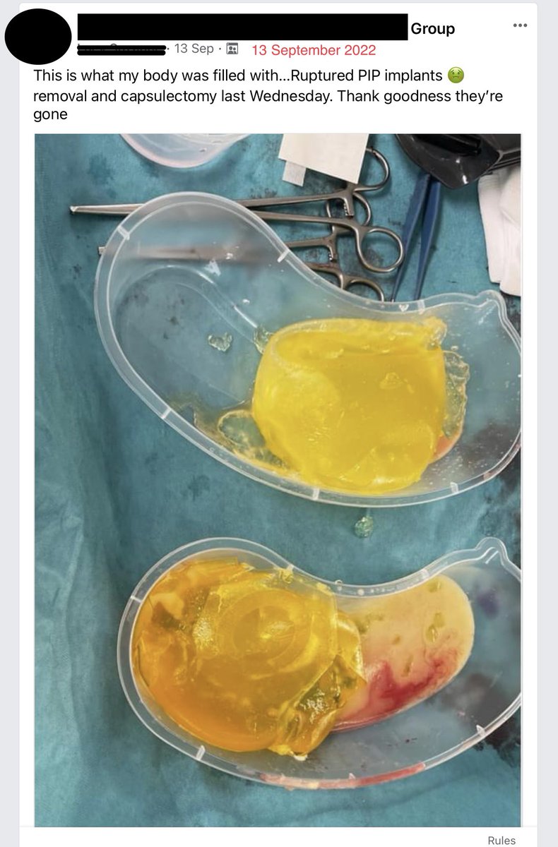 PIPActionA's tweet photo. Imagine a Health & Safety Regulator OBSTRUCTING women from #Healthcare HIDING data about #PIPIMPLANT DEATHS & SERIOUS injuries & then using SALES figures to imply risks are “VERY RARE” #PIPcrimes #CriminalNegligence @mariacaulfield @FeryalClark @PutneyFleur #IMPLANTfiles https://t.co/UXJBGfqzaO