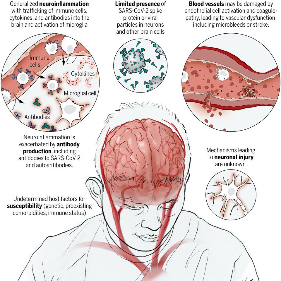 neurological symptoms that accompany #COVID19 and the possible mechanisms that cause them

@ScienceMagazine #scicomm #news #Technology #Tech #NewsBreak #Trending #research #science #AcademicTwitter #MedEd #MedTwitter 

Free access
science.org/doi/10.1126/sc…