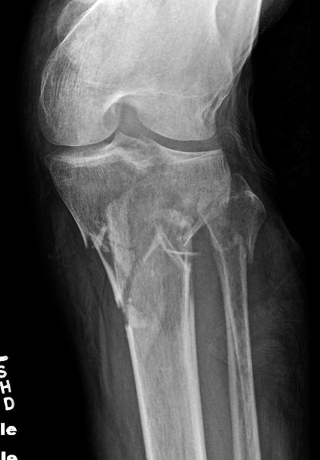 Complex Ribia Fracture Dr. Edward Oates on Twitter: