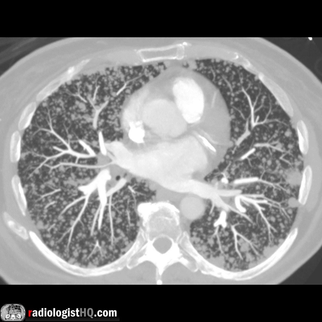 Miliary pulmonary metastases. Random distribution of micronodules. Miliary nodules usually infectious (TB, fungal) but have many causes including metastatic disease (thyroid & renal cell carcinoma). Rare example of miliary metastatic pancreatic adenocarcinoma. #FOAMrad #chestrad