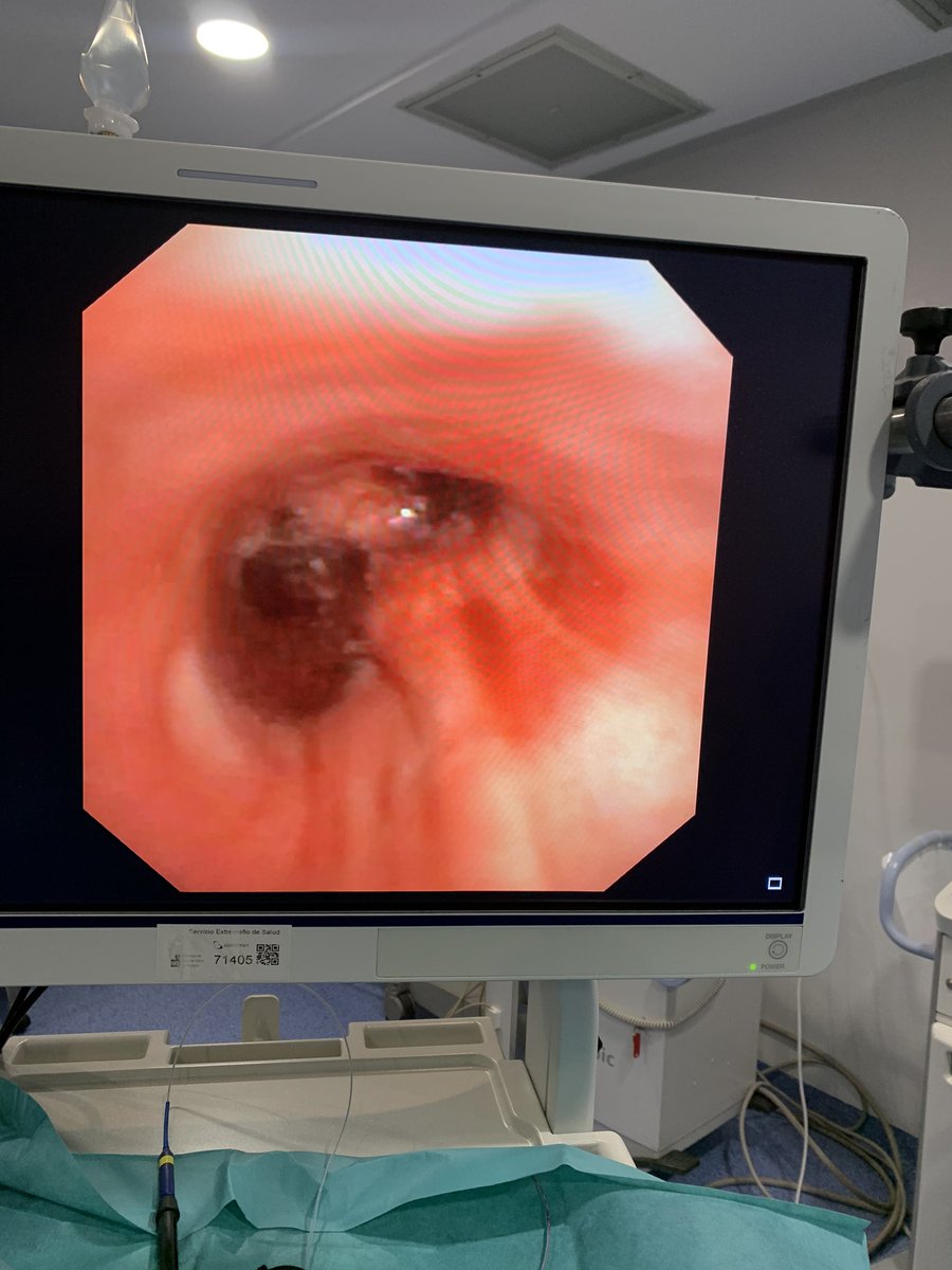 santihergoneumo's tweet photo. Tumoración endobronquial que obstruye >90% de la luz del BPD, se realiza control de sangrado con plasma argón y recanalización con asa de diatermia, liberando LSD y parcialmente LM. #HospitalUniversitariodeBadajoz #NeumologiaIntervencionista #Cancerdepulmon https://t.co/grwsNT46Yn