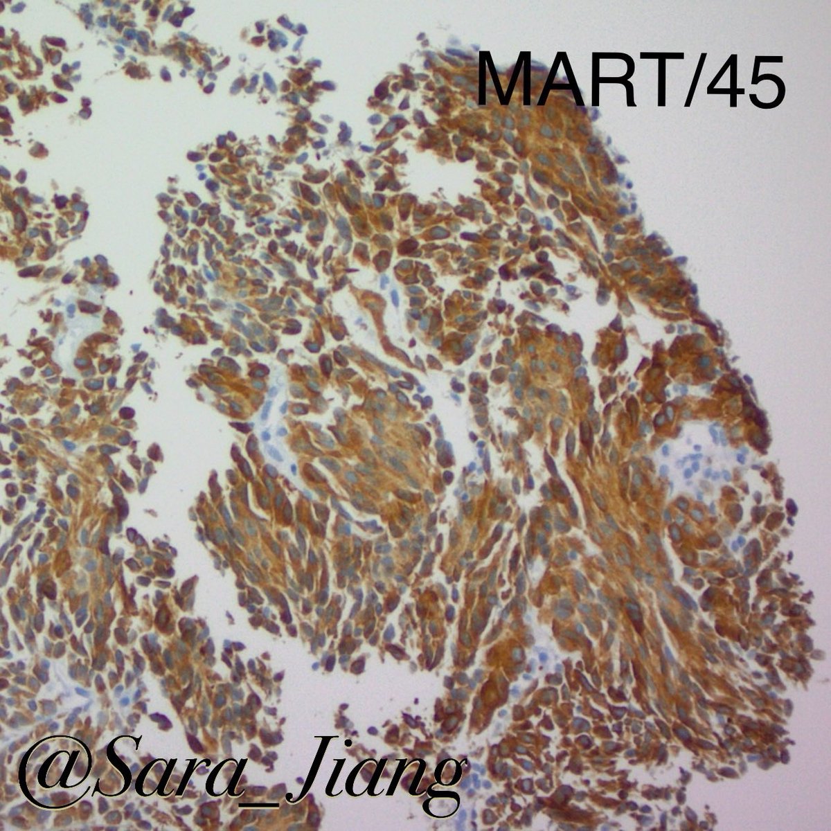 Sara_Jiang's tweet photo. Today’s #FNAFriday #CytoHisto correlation
🤔Deceptively bland metastatic melanoma-even bubbles in the background like you’d see in normal adrenal cortex!
(L: H&E R:DQ)
🟤(+) MART/45, SOX10
👉🏼#PathPitfall: adrenal cortex is positive for Melan-A! https://t.co/WoiAGqoIHW