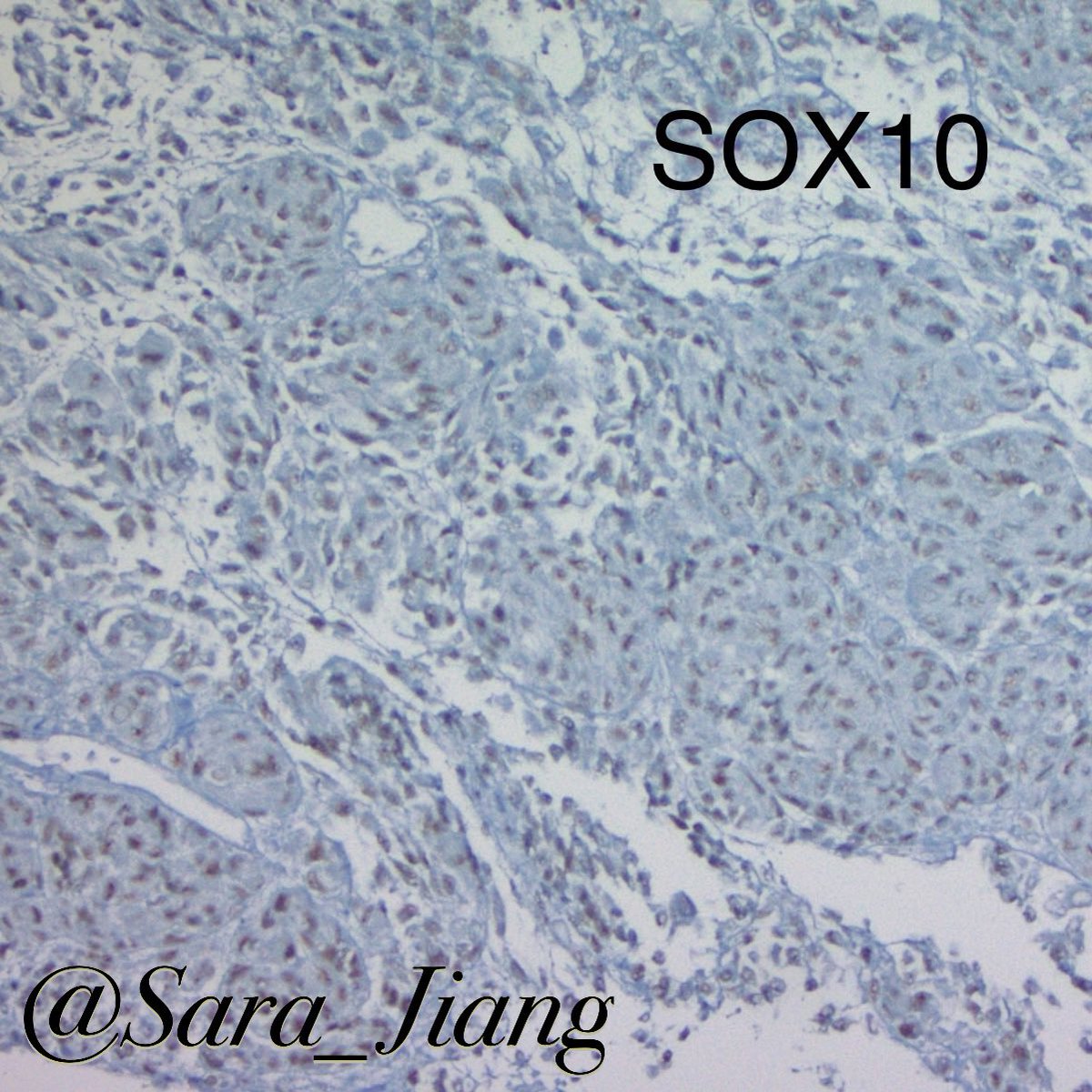 Sara_Jiang's tweet photo. Today’s #FNAFriday #CytoHisto correlation
🤔Deceptively bland metastatic melanoma-even bubbles in the background like you’d see in normal adrenal cortex!
(L: H&E R:DQ)
🟤(+) MART/45, SOX10
👉🏼#PathPitfall: adrenal cortex is positive for Melan-A! https://t.co/WoiAGqoIHW