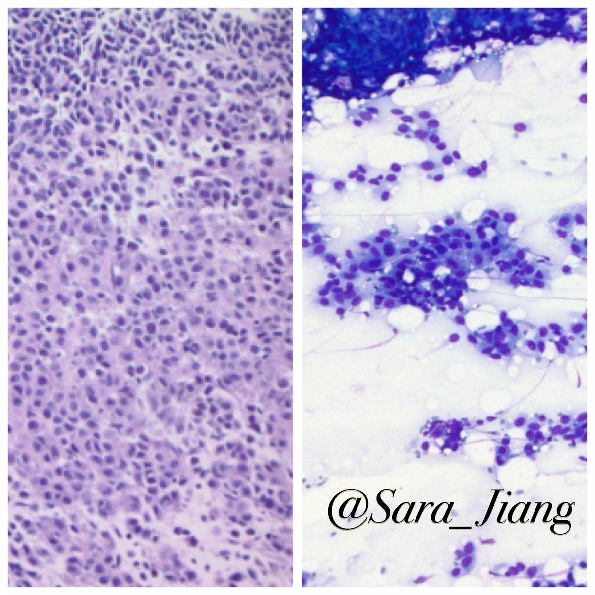 Sara_Jiang's tweet photo. Today’s #FNAFriday #CytoHisto correlation
🤔Deceptively bland metastatic melanoma-even bubbles in the background like you’d see in normal adrenal cortex!
(L: H&E R:DQ)
🟤(+) MART/45, SOX10
👉🏼#PathPitfall: adrenal cortex is positive for Melan-A! https://t.co/WoiAGqoIHW