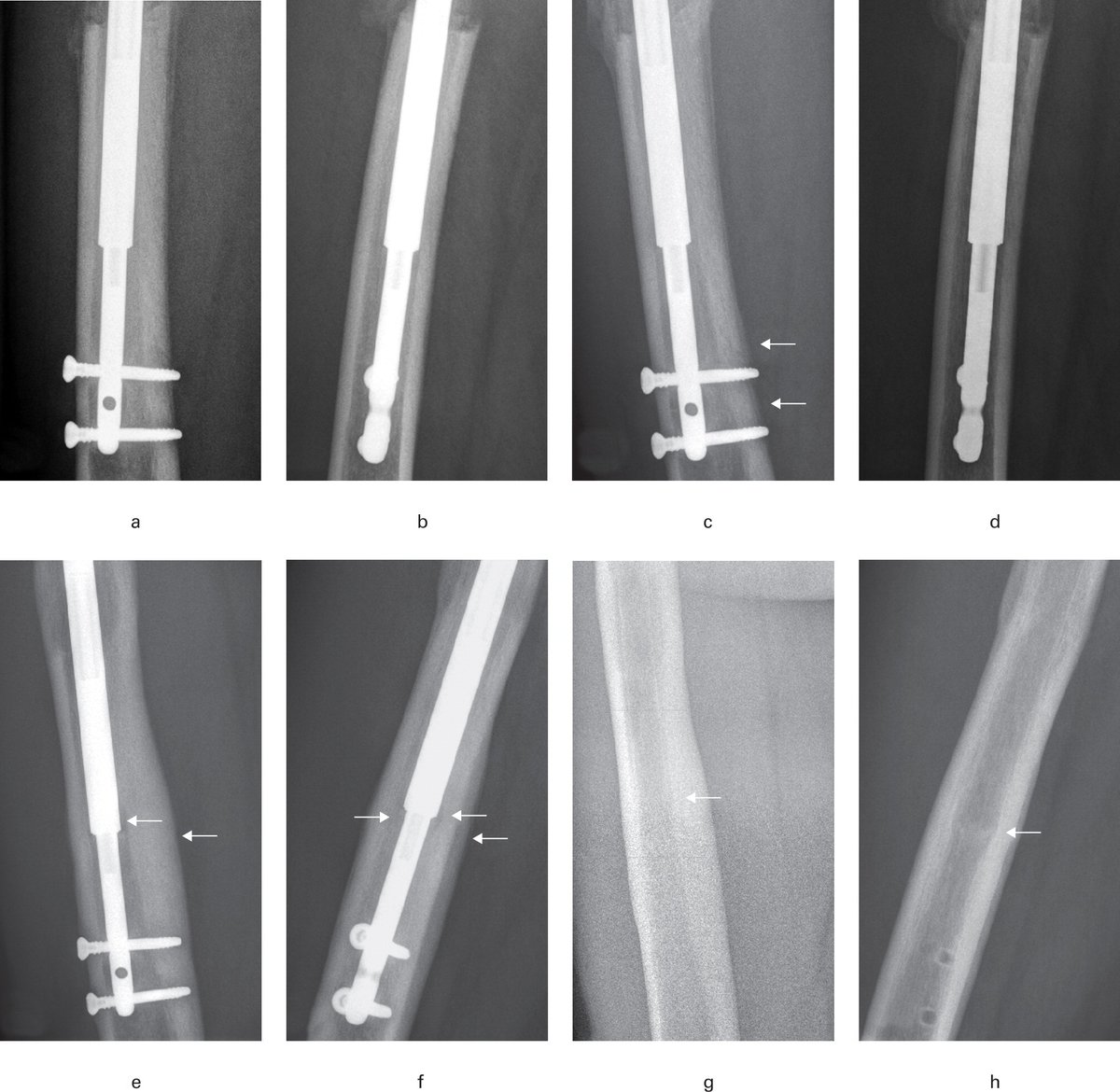 Osteolysis and periosteal reaction, implant breakage, and pain during lengthening and consolidation is more likely in patients treated with the STRYDE nail compared to the PRECICE nail. 

#Implant #Surgery #Ortho #BJJ

ow.ly/K1Fl50Miko7