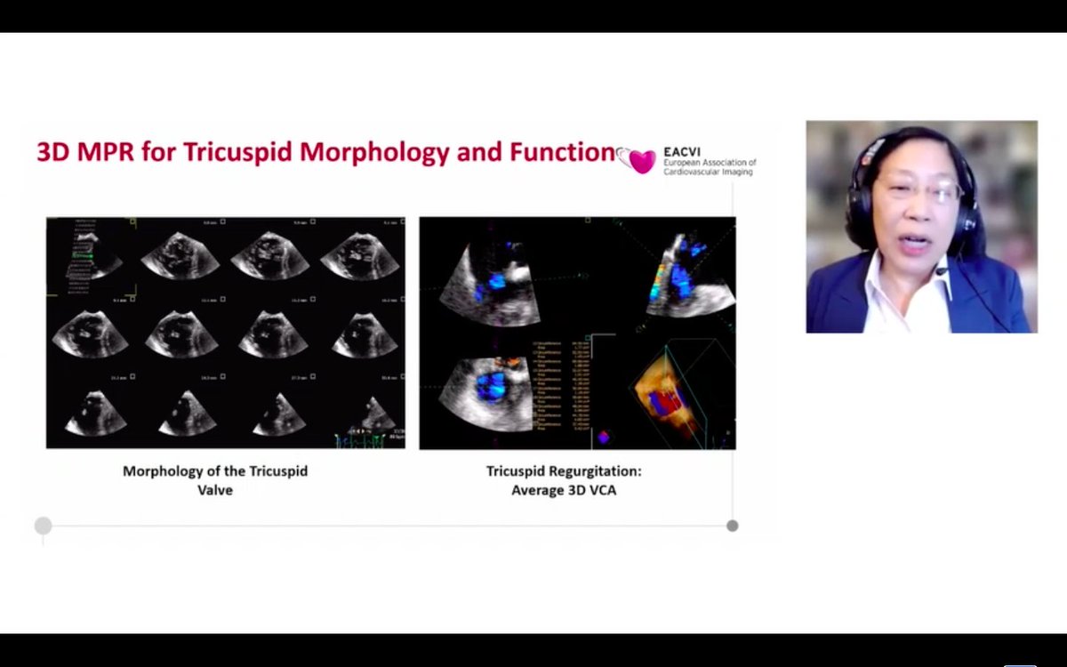 eromerodorta's tweet photo. As usual excellent lecture by @hahn_rt focusing on the use of 3D echo in the evaluation of TV and TR on @escardio #esc365 #EACVI 
🚩Host @NAjmoneMarsan 🚩great co-speakers F.Faletra and @bibi0562 

#Berlin3Decho @NMerke @VDelgadoGarcia @KemalogluOz @esrakaya_dr @echo_stepbystep https://t.co/TYosRR52sj