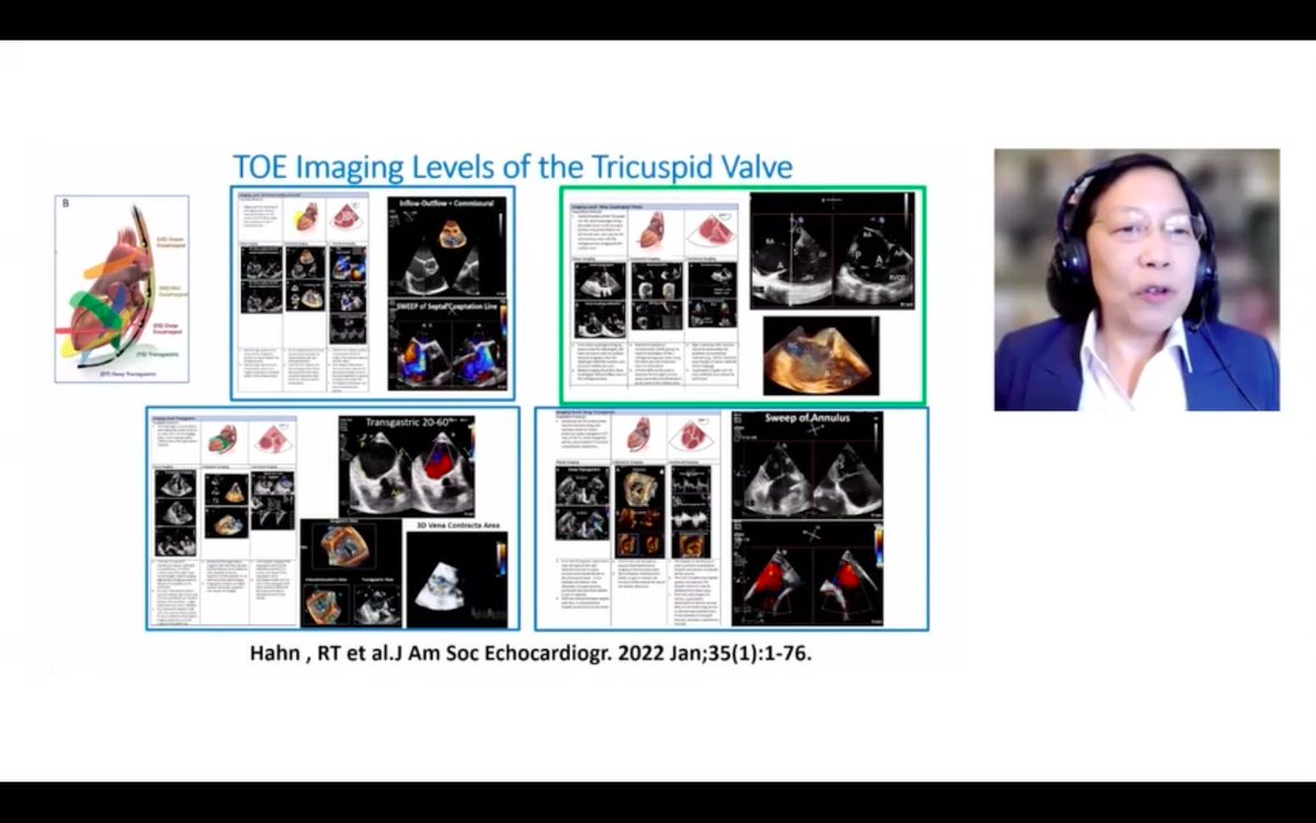 eromerodorta's tweet photo. As usual excellent lecture by @hahn_rt focusing on the use of 3D echo in the evaluation of TV and TR on @escardio #esc365 #EACVI 
🚩Host @NAjmoneMarsan 🚩great co-speakers F.Faletra and @bibi0562 

#Berlin3Decho @NMerke @VDelgadoGarcia @KemalogluOz @esrakaya_dr @echo_stepbystep https://t.co/TYosRR52sj