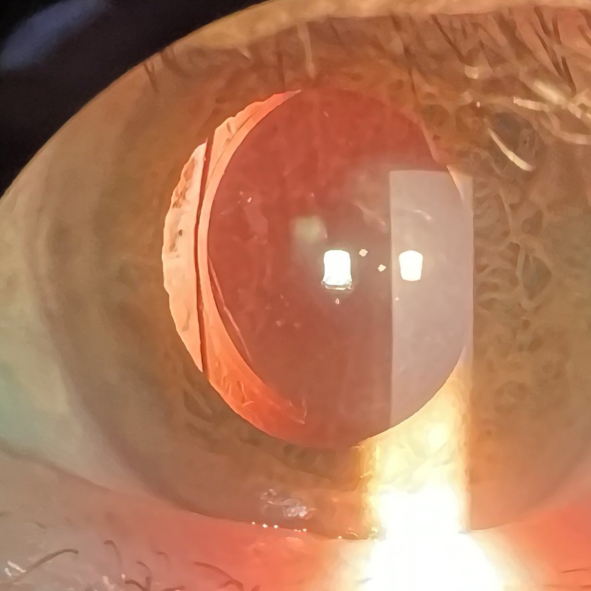 IOLReference's tweet image. STAAR plate haptic IOL, it looks like the Collamer CC4204BF? 
Cataract Surgery: 20 Years Ago
#ophthalmology #ophthotwitter