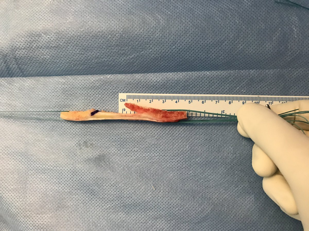 ligamentsurgeon's tweet photo. @malempatisports Cheers from another BTB fan. Why stop with high performance athletes? it’s a graft for heavy manual labourers too:) BTB = Gold🫶 https://t.co/UgkXnw7R9R