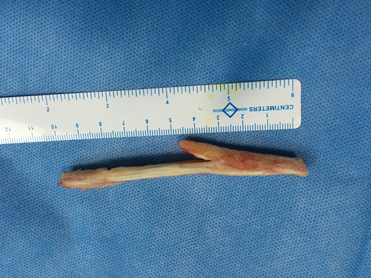 ligamentsurgeon's tweet photo. @malempatisports Cheers from another BTB fan. Why stop with high performance athletes? it’s a graft for heavy manual labourers too:) BTB = Gold🫶 https://t.co/UgkXnw7R9R