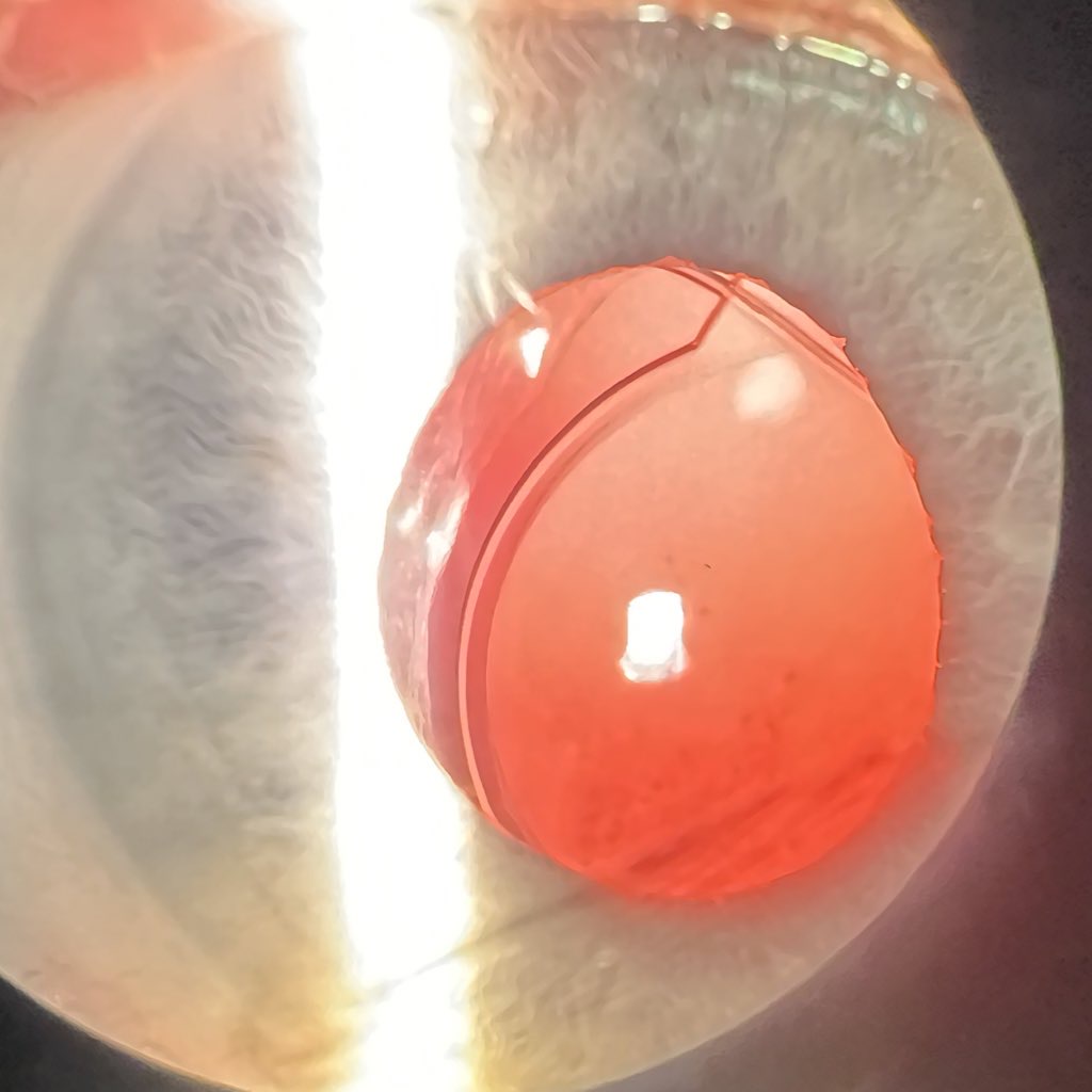 IOLReference's tweet image. AMO PhacoFlex II Model SI40NB. 
Cataract Surgery: ~2010
#ophthalmology #Ophthotwitter