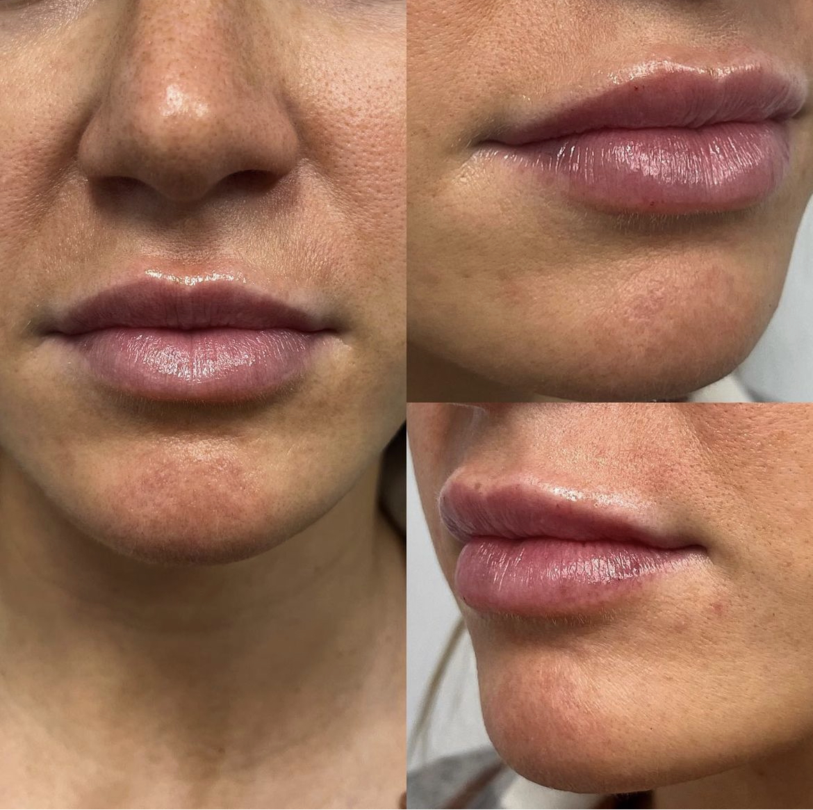 Bloom Plastic Surgery (@drjacobbloom) on Twitter photo For a limited time, save $200 on <a href="/juvederm/">JUVÉDERM® Collection of Fillers</a> UltraXC lip filler treatment. Book with Lauren before Feb 23, 2023 (while supplies last) to take advantage of these incredible savings! 📲 Call or Text: 312.549.8691 to book. For a limited time, save $200 on <a href="/juvederm/">JUVÉDERM® Collection of Fillers</a> UltraXC lip filler treatment. Book with Lauren before Feb 23, 2023 (while supplies last) to take advantage of these incredible savings! 📲 Call or Text: 312.549.8691 to book.
