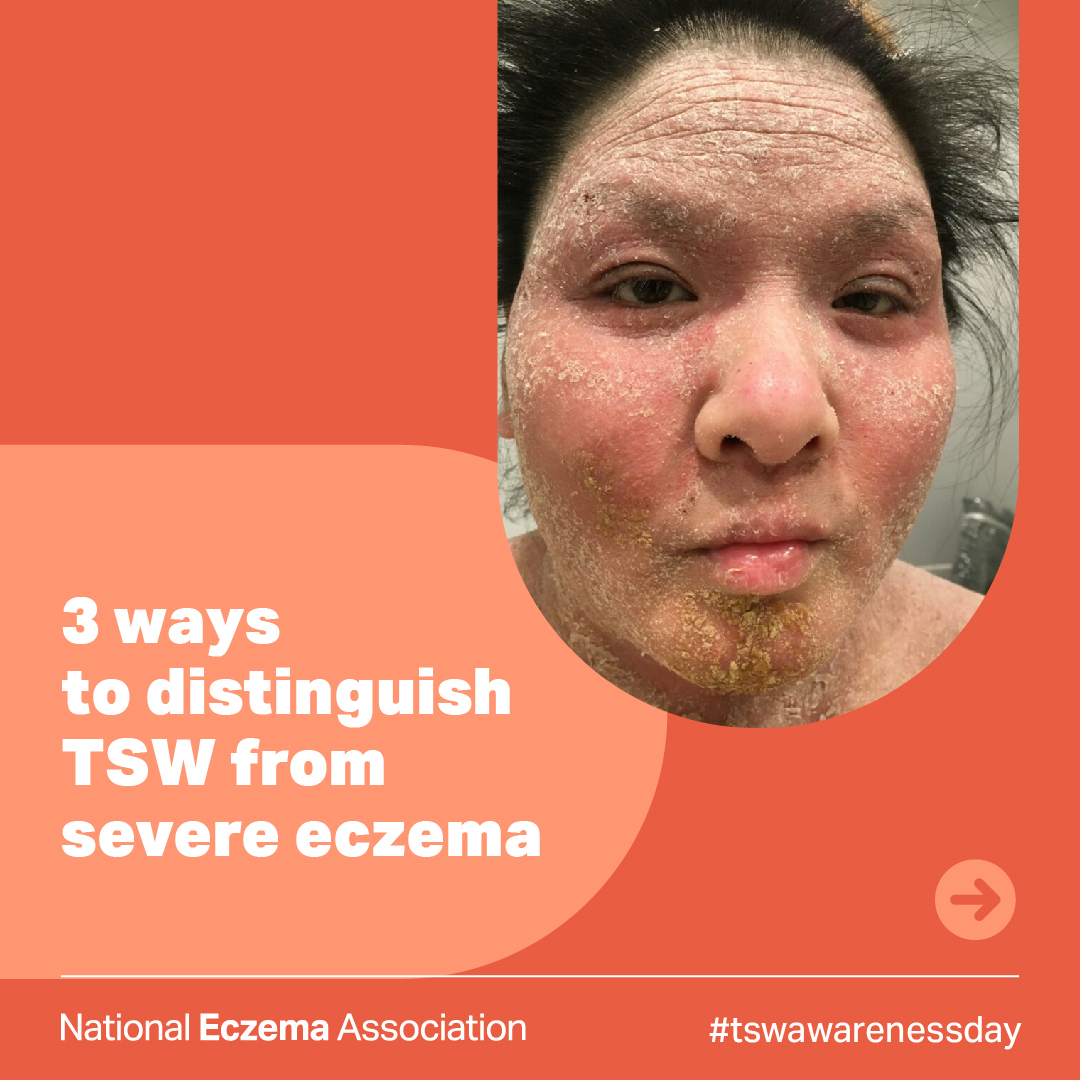 nationaleczema's tweet photo. Today is #TopicalSteroidWithdrawalAwareness Day.

Visit @ITSANnonprofit to learn more about ways to support the #TSWcommunity. 

Learn more about #TSW: https://t.co/dFt9jmXMtx

#tswawarenessday #endtsw #thisisnoteczema #dermatology #eczema #tswawareness #atopicdermatitis https://t.co/fOmsZUhbtd