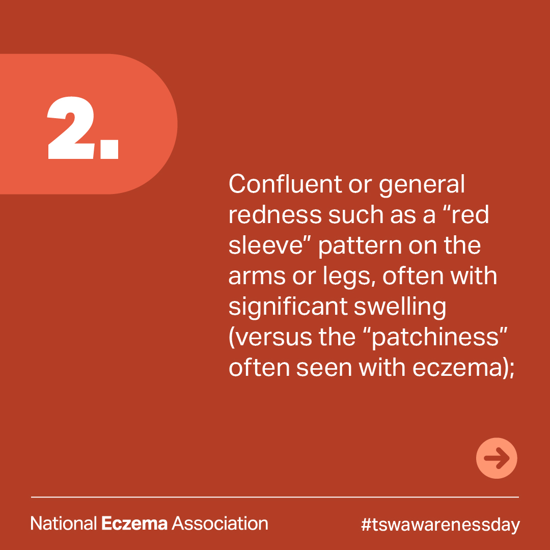 nationaleczema's tweet photo. Today is #TopicalSteroidWithdrawalAwareness Day.

Visit @ITSANnonprofit to learn more about ways to support the #TSWcommunity. 

Learn more about #TSW: https://t.co/dFt9jmXMtx

#tswawarenessday #endtsw #thisisnoteczema #dermatology #eczema #tswawareness #atopicdermatitis https://t.co/fOmsZUhbtd