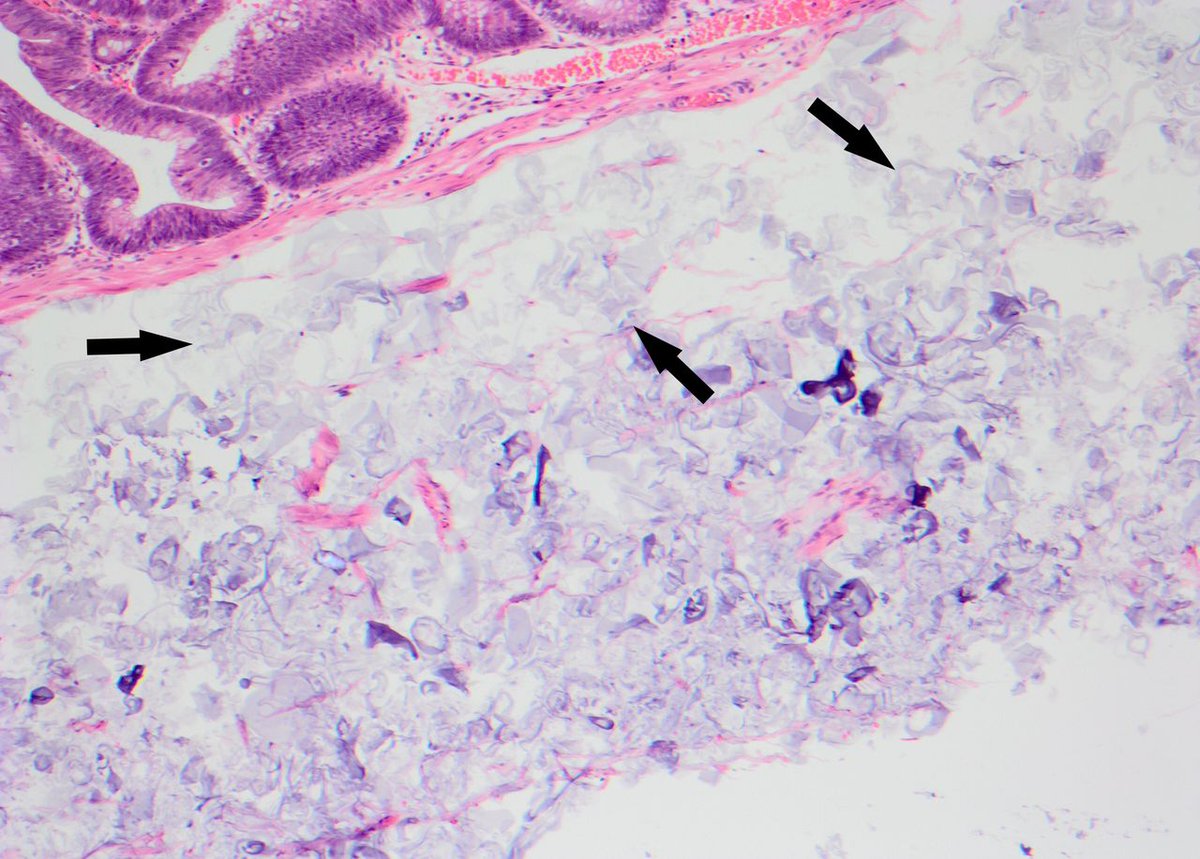 FrontGastro_BMJ's tweet image. Read the #InsideView by #InsideView @Bjorn_Rembacken et al on 

&quot;Lifting agents in endoscopic resection: a cause for histological disquietude?&quot; via

bit.ly/3HIeErZ

#Endoscopy
