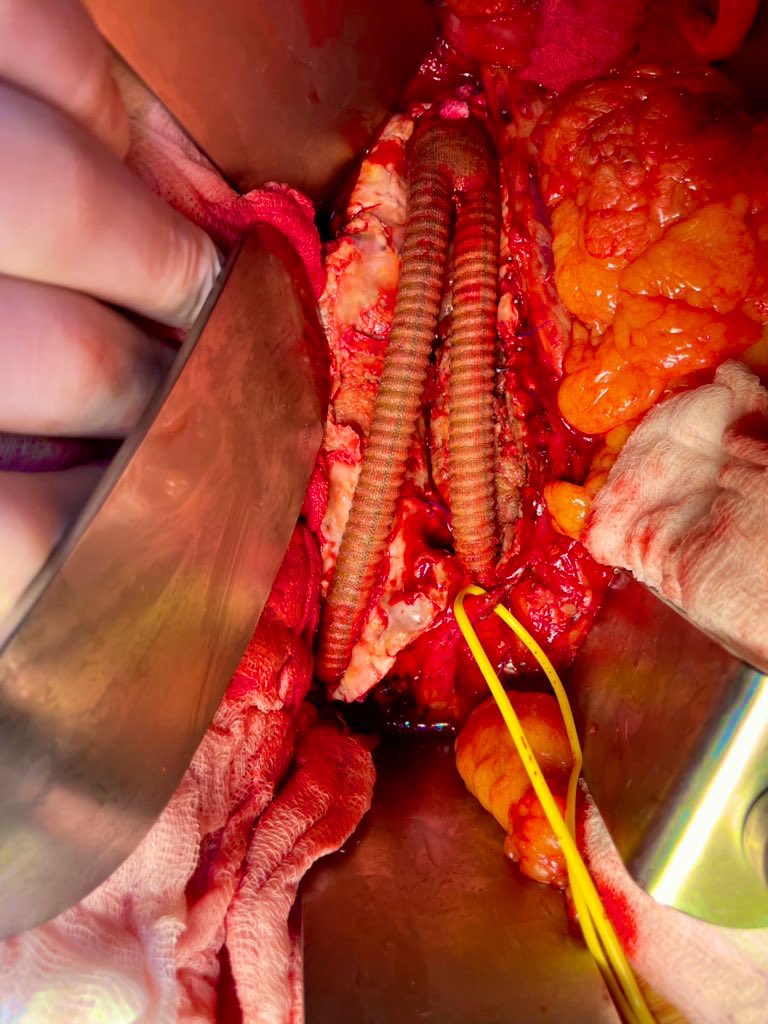 “Friday” #veterosurgery #aorta #aortaEd