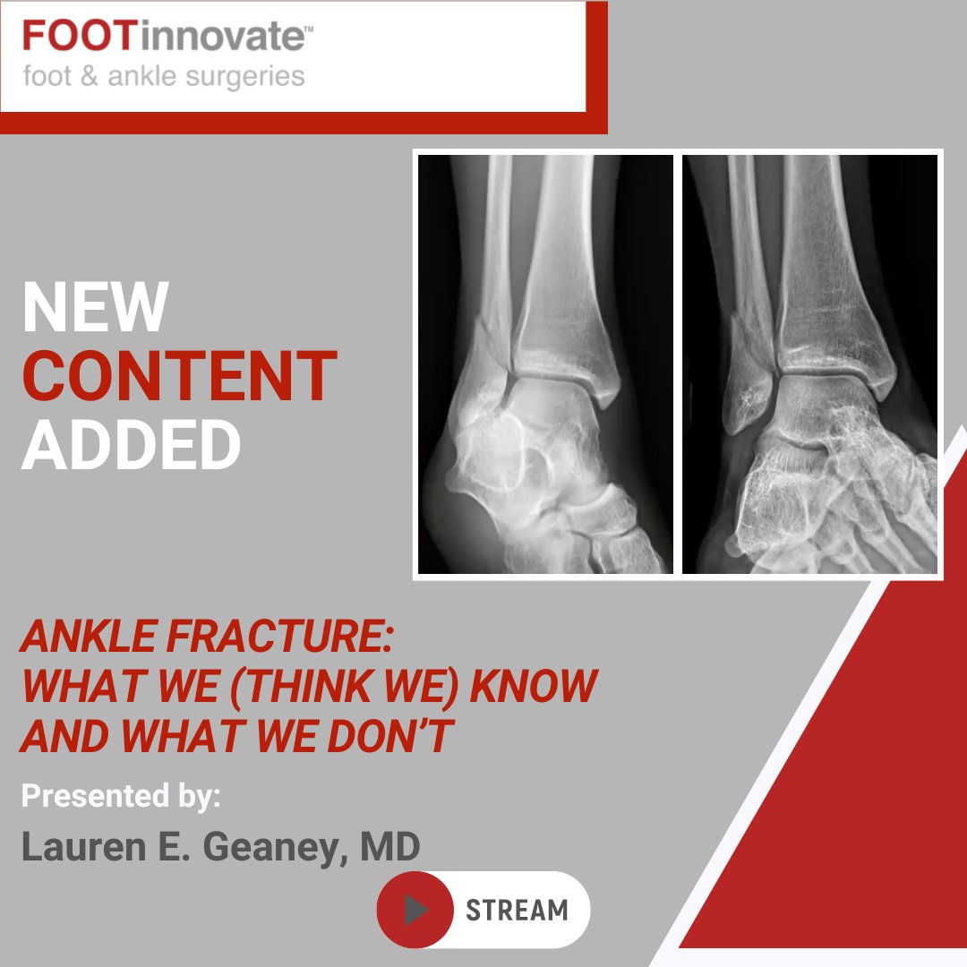 FootInnovate's tweet photo. STREAM NOW: https://t.co/EAfhIzFwWq
Ankle Fracture: What We (Think We) Know and What We Don’t with Lauren E. Geaney, MD, of the UConn Musculoskeletal Institute at UConn Health. 

Watch at your convenience on Foot Innovate. #anklefractures #fractures #orthopedics #podiatry #meded https://t.co/PDAlxivvCr