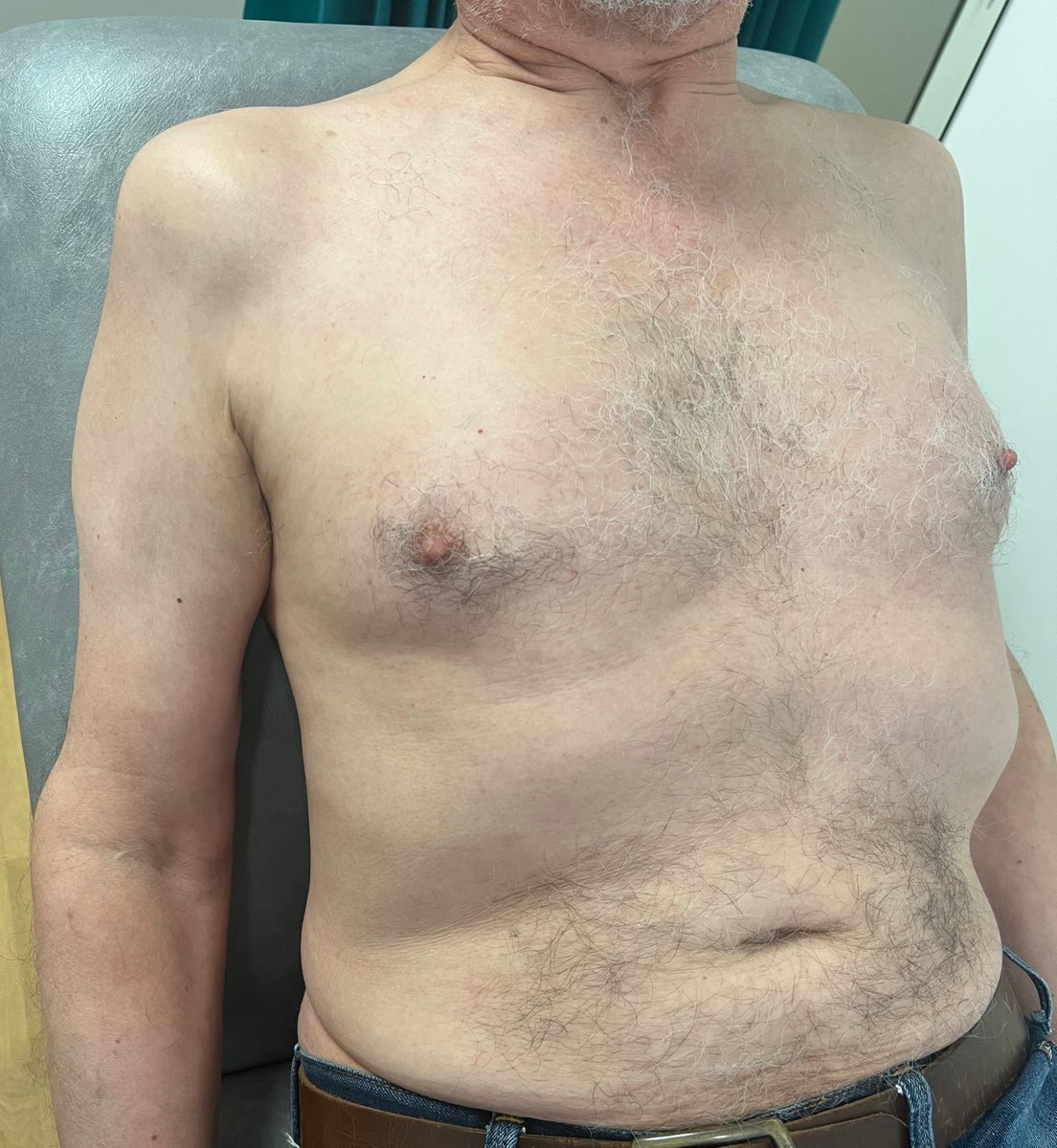 Consent ✅

A case to make you think a bit harder 🧐

66 M, anterior dislocation shoulder skiing 6 weeks ago - relocated in resort - no fracture 

Immediate loss of sensation military badge area, profound loss of shoulder abduction &amp; rotation 

What do images below show?