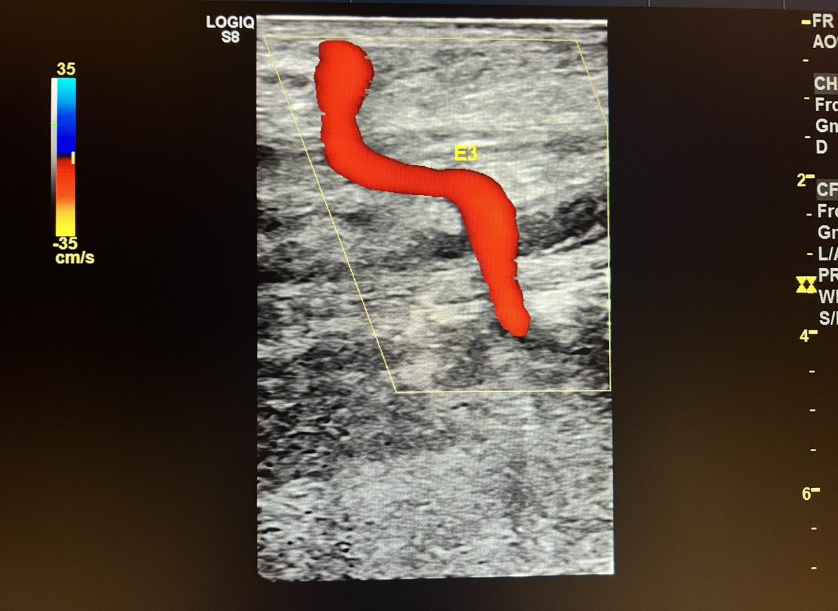 ChaconMatoso's tweet photo. 64 y/o, male, surveillance with vascular Doppler of femorofibular bypass with devalved in situ magana sphenous vein. #vasculardoppler #vascular #bypass https://t.co/x4NI9qHfen
