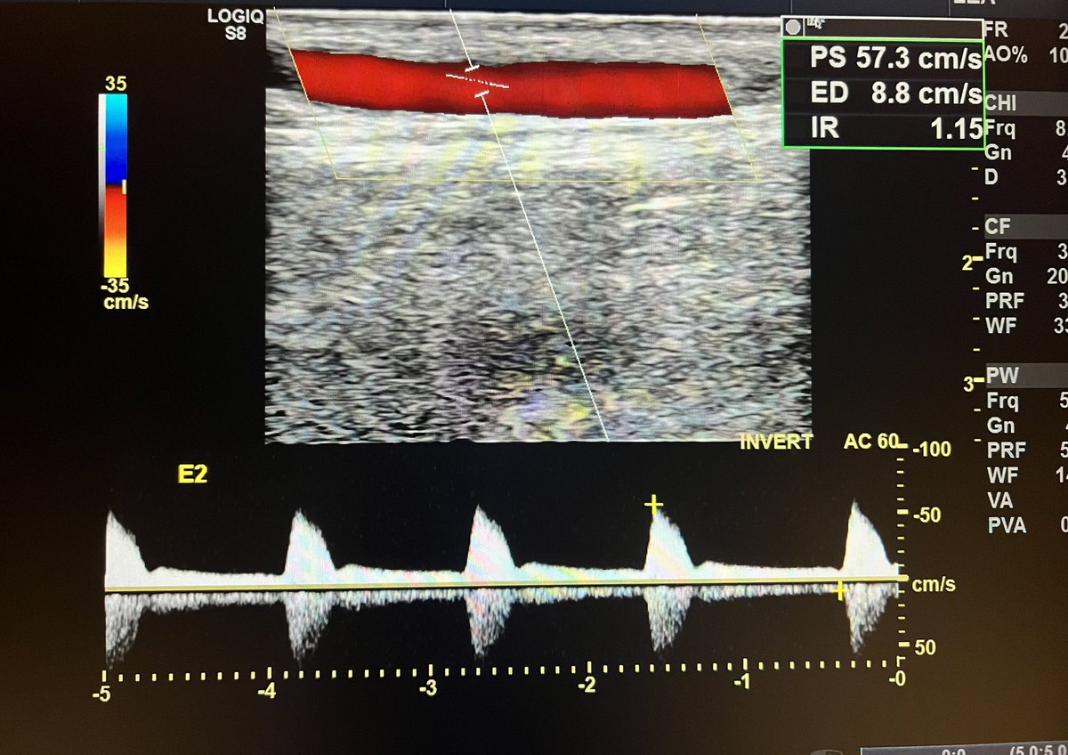ChaconMatoso's tweet photo. 64 y/o, male, surveillance with vascular Doppler of femorofibular bypass with devalved in situ magana sphenous vein. #vasculardoppler #vascular #bypass https://t.co/x4NI9qHfen