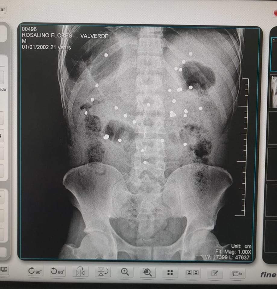 ChacoteroPeru's tweet photo. En Cusco el 11 de Enero 2023 Rosalino Flores Valverde de 21 años recibió 30 disparos de perdigones, en el vídeo se ve como la inmaculada Policía Nacional del Perú le dispara por la espalda cuando estaba parado en un árbol y sale corriendo ahora está en UCI en el hospital Loayza https://t.co/fQlx32dRfm