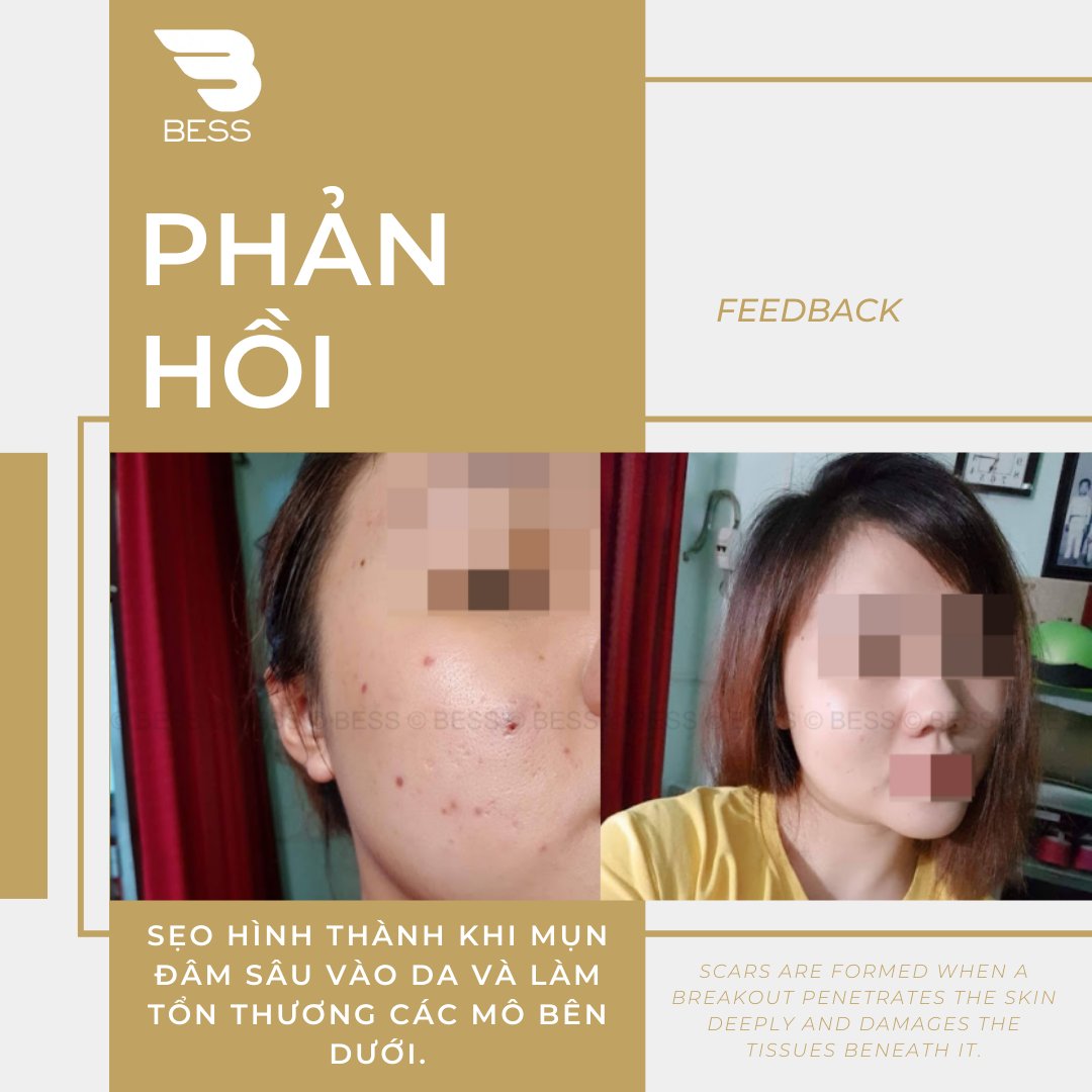 thisisbalmistry's tweet photo. Sẹo hình thành khi mụn đâm sâu vào da và làm tổn thương các mô bên dưới: https://t.co/KNaZAbNLjN
#BESSOFFICIAL #skincare #beauty #skincareroutine #makeup #skin #skincareproducts #selfcare #skincaretips #antiaging #glowingskin #love #cosmetics #facial #healthyskin #natural https://t.co/MwTRMz8ORR