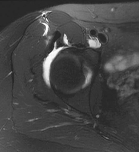 UW_MSKrad's tweet photo. #CaseOfTheWeek 🎉
📣✅Answer for Case #5: Normal➡️iliopsoas bursa is the largest in the body and communicates with the hip joint in up to 15% of patients!
Stay tuned for next week's Case #6 and have a great weekend 🩻
#MSKRad #MSKIntervention #FOAMrad #radres #OrthoTwitter https://t.co/J1WYpqFEwL