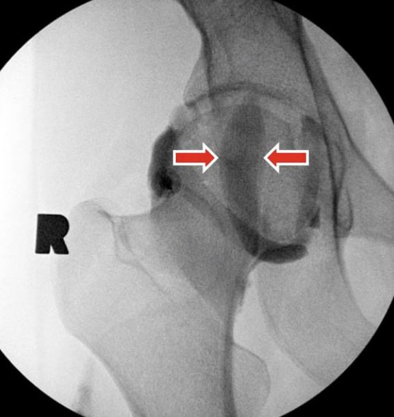 UW_MSKrad's tweet photo. #CaseOfTheWeek 🎉
📣✅Answer for Case #5: Normal➡️iliopsoas bursa is the largest in the body and communicates with the hip joint in up to 15% of patients!
Stay tuned for next week's Case #6 and have a great weekend 🩻
#MSKRad #MSKIntervention #FOAMrad #radres #OrthoTwitter https://t.co/J1WYpqFEwL