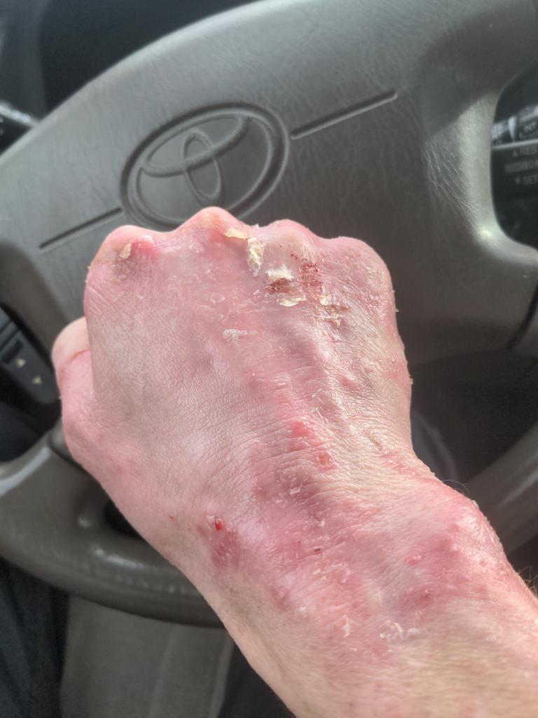LarsWilliam1980's tweet photo. Fasted hour 110. significant improvement in excema. Noticeable healing started after 70hours. #excema #carnivorecure #carnivorediet https://t.co/MZ90pFG2cj