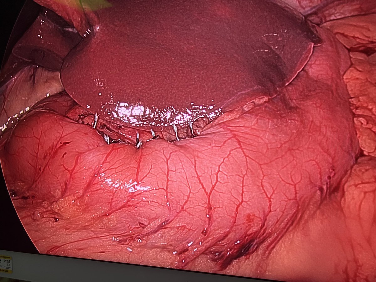 Shaun C. Daly, MD, FACS (@shaundaly81) on Twitter photo Foregut Friday! 7.1 cm Gastric Mass on Posterior Lesser Curvature. Final Result. What was the Preoperative Diagnosis? Margins? What Complication To Avoid Based on Location? Other Options? <a href="/SAGES_Updates/">SAGES is in Tampa in 2026!</a> <a href="/ForegutSociety/">The American Foregut Society</a> <a href="/SoCalSurgeons/">SoCal Chapter - American College of Surgeons</a> <a href="/AmCollSurgeons/">American College of Surgeons</a> <a href="/UCIrvineSurgery/">UC Irvine Surgery</a> Foregut Friday! 7.1 cm Gastric Mass on Posterior Lesser Curvature. Final Result. What was the Preoperative Diagnosis? Margins? What Complication To Avoid Based on Location? Other Options? <a href="/SAGES_Updates/">SAGES is in Tampa in 2026!</a> <a href="/ForegutSociety/">The American Foregut Society</a> <a href="/SoCalSurgeons/">SoCal Chapter - American College of Surgeons</a> <a href="/AmCollSurgeons/">American College of Surgeons</a> <a href="/UCIrvineSurgery/">UC Irvine Surgery</a>