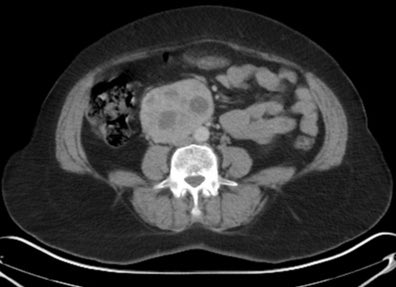 Radiopaedia's tweet photo. 50yo female with a hypervascular retroperitoenal mass. In this particular location, what do you suspect it may be? 

ANSWER: https://t.co/PpW26w6G8G

Case contributed by Rania Adel Anan #foamrad #abdorad https://t.co/qXrlkAplkS