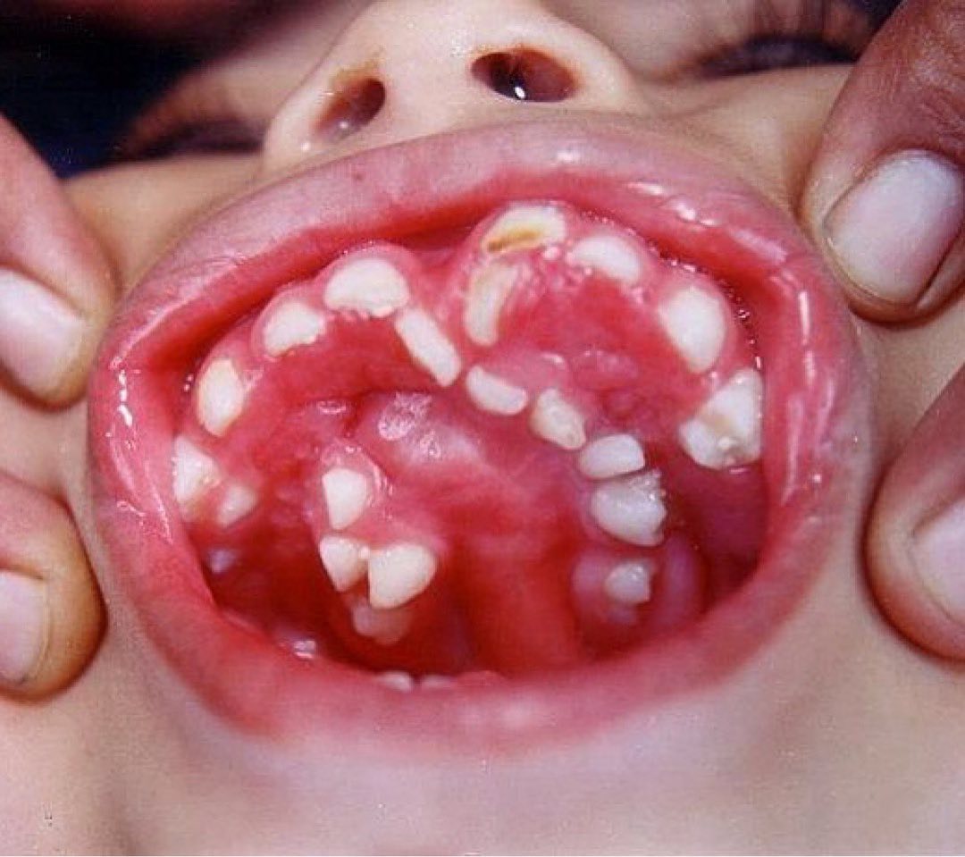 meducasion's tweet photo. HYPERDONTIA
the condition of having supernumerary teeth or teeth that appear in addition to the regular number of teeth

patients often demonstrate teeth that are larger in size with a more complex anatomy.
The additional teeth may be single or multiple, unilateral or bilateral https://t.co/3yXoGztKas