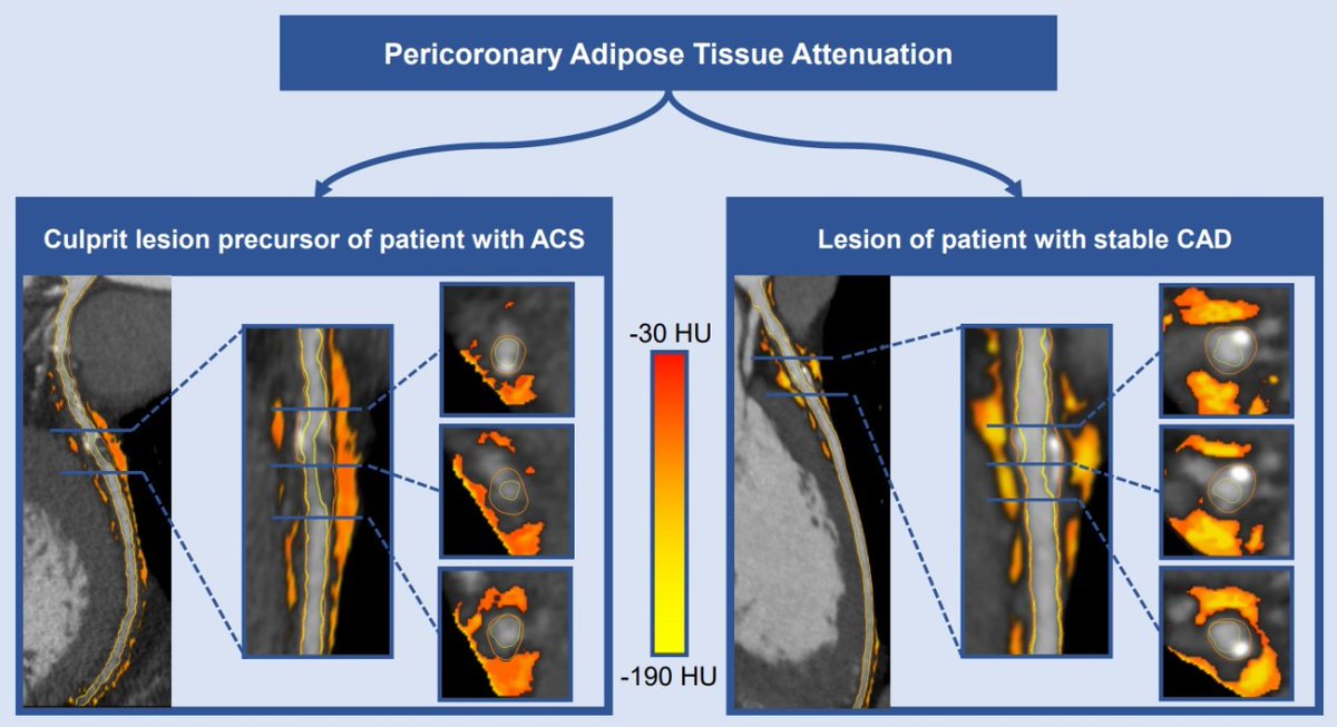 Pericoronary adipose tissue attenuation on CCTA is increased across culprit lesions of patients who developed an ACS, suggesting a higher activity of inflammation @jhkuneman @Hartcentrum @AllisonGHaysMD #AHAJournals ahajrnls.org/40tsMfL