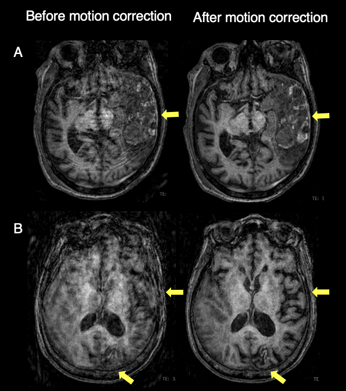 Azadeh Tabari (@azitabari) on Twitter photo The first paper on the clinical evaluation of SAMER technique is out in <a href="/TheAJNR/">AJNR</a>
Impact: 69% of the nondiagnostic cases were considered diagnostic in quality after SAMER motion correction. DOI: 10.3174/ajnr.A7777
Thanks to <a href="/MinLangMD/">Min Lang</a> <a href="/drjohnconklin/">John Conklin</a> <a href="/SusieHuangMDPhD/">Susie Huang</a> <a href="/MGHImaging/">Mass General Imaging</a> The first paper on the clinical evaluation of SAMER technique is out in <a href="/TheAJNR/">AJNR</a>
Impact: 69% of the nondiagnostic cases were considered diagnostic in quality after SAMER motion correction. DOI: 10.3174/ajnr.A7777
Thanks to <a href="/MinLangMD/">Min Lang</a> <a href="/drjohnconklin/">John Conklin</a> <a href="/SusieHuangMDPhD/">Susie Huang</a> <a href="/MGHImaging/">Mass General Imaging</a>