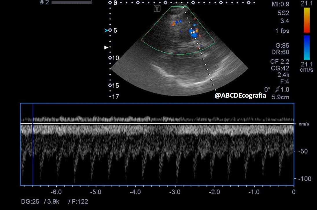 Color coded transcranial duplex, transtemporal window: spectral recording of posterior cerebral artery (P2) and basal vein of Rosenthal.
#NeuroCritCare, #ICU, #WINFOCUS, #POCUS, #ASARUC