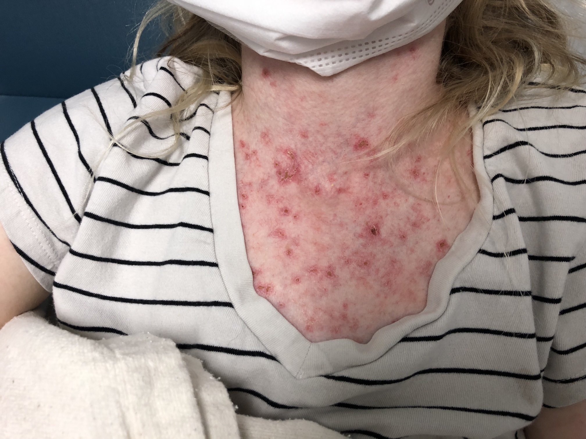 Prednisone Rashes Strong Dose Prednisone Cause Rash Managing Prednisone Side Effects