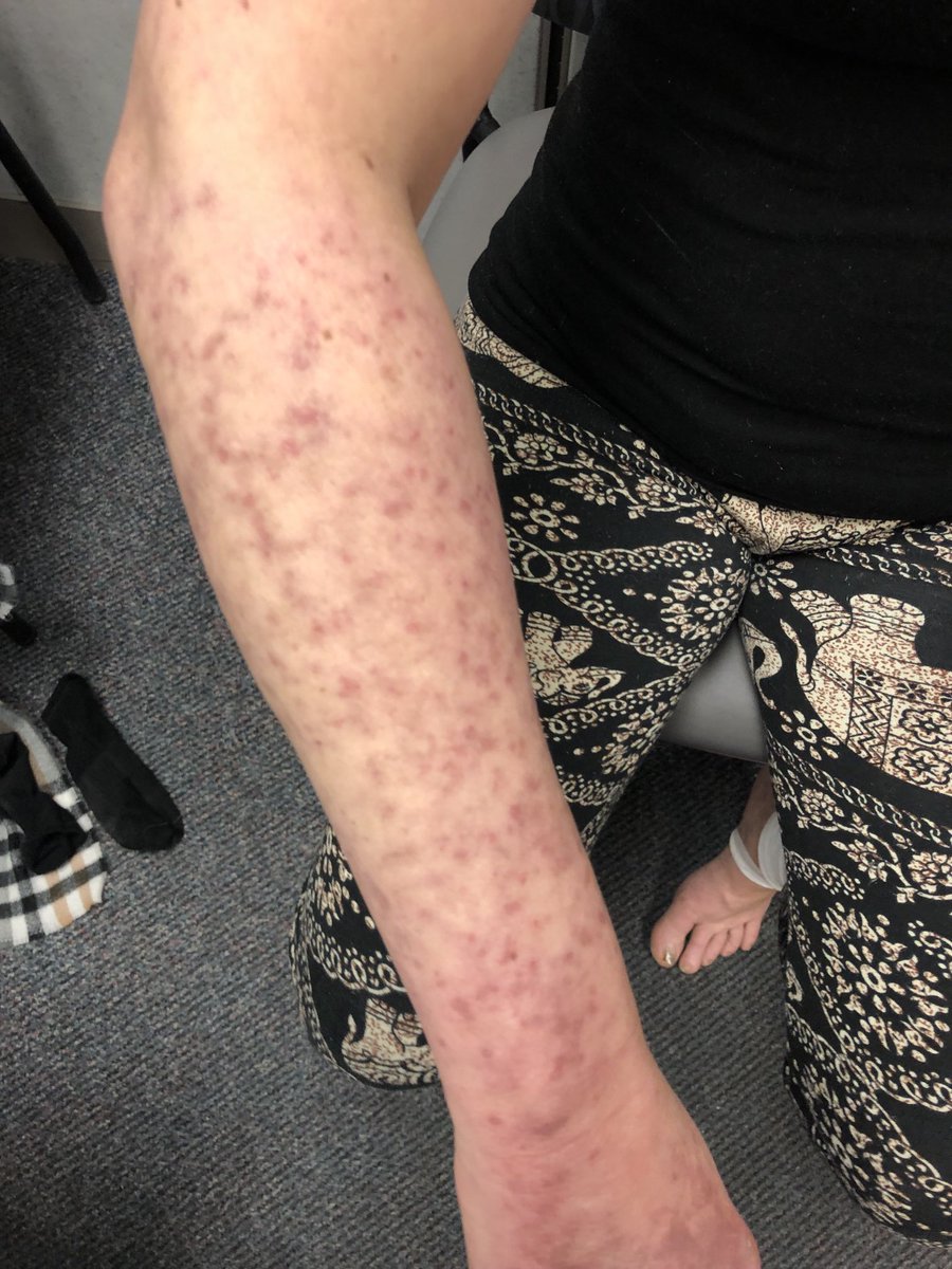 Janetbirdope's tweet photo. #ClinicalPearl Active rash from #SLE #lupus with raised macular popular and circle shows #livedo #reticularis What antibodies do you think are likely to be +. Hint at least 3. #MedTwitter https://t.co/3nLqMrFIqo