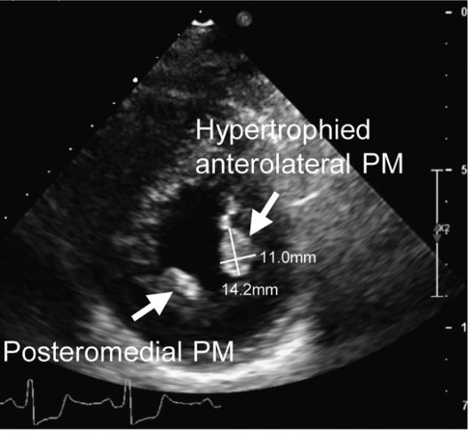 <a href="/JournalASEcho/">JASE</a> review of Submitral Apparatus role in HOCM
  
🫀Anomalous papillary muscles important causes of LVOTO in HOCM

🫀secondary chordae are fibrotic thickened &amp; retracted in HOCM

🫀Anomalous muscle bundles in most HOCM &amp; in all w latent HOCM bit.ly/3X4JXl8