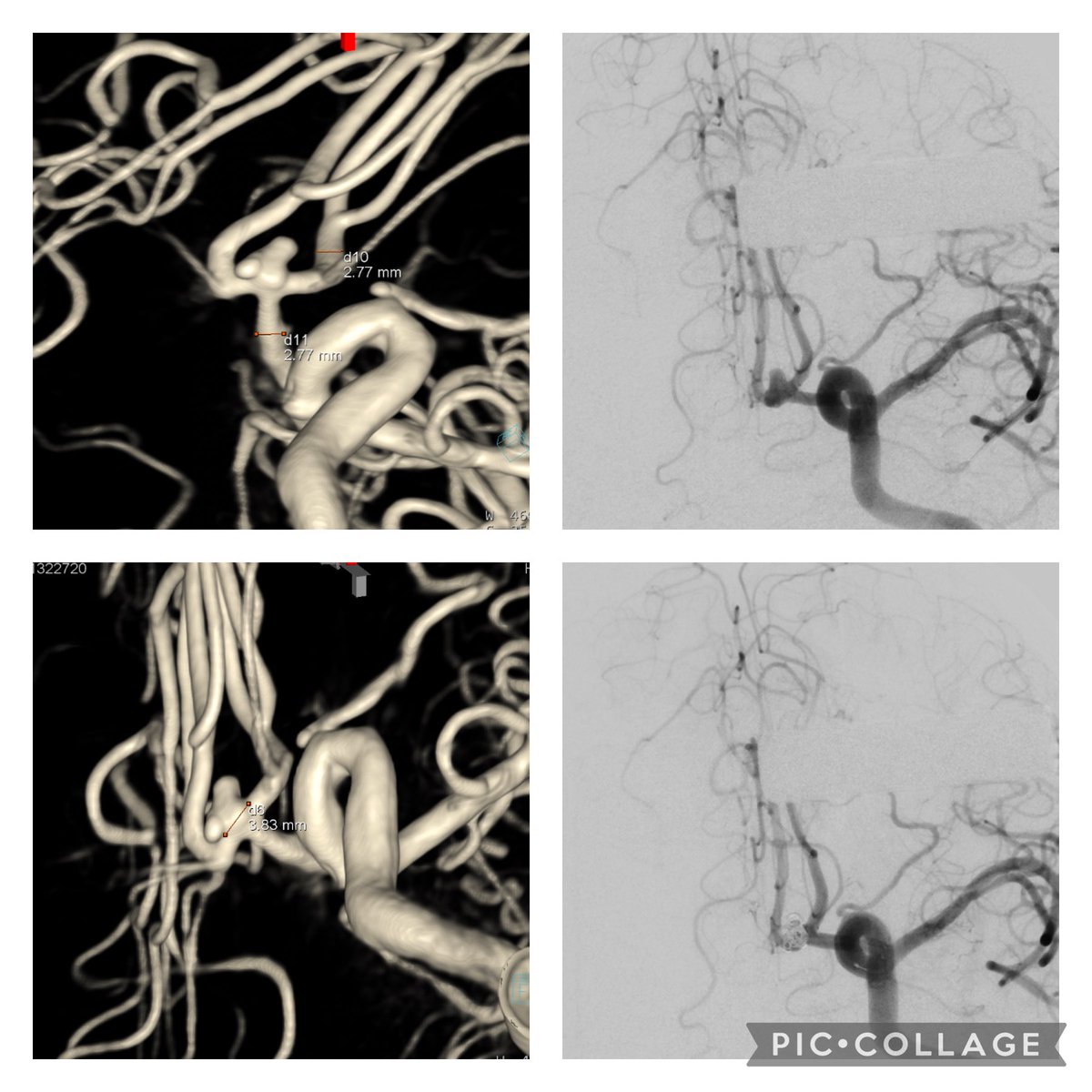 RababThamer's tweet photo. Finishing a #cerebrovascular week @THP_hospital with stent assisted coiling of 2 ACOM aneurysms and MCA aneurysm clipping. @cvsection @svinsociety @SNISinfo @BAFOUND    @neurosurgatlas @YoungNIR @youngneuros https://t.co/CnJUzLGrVq