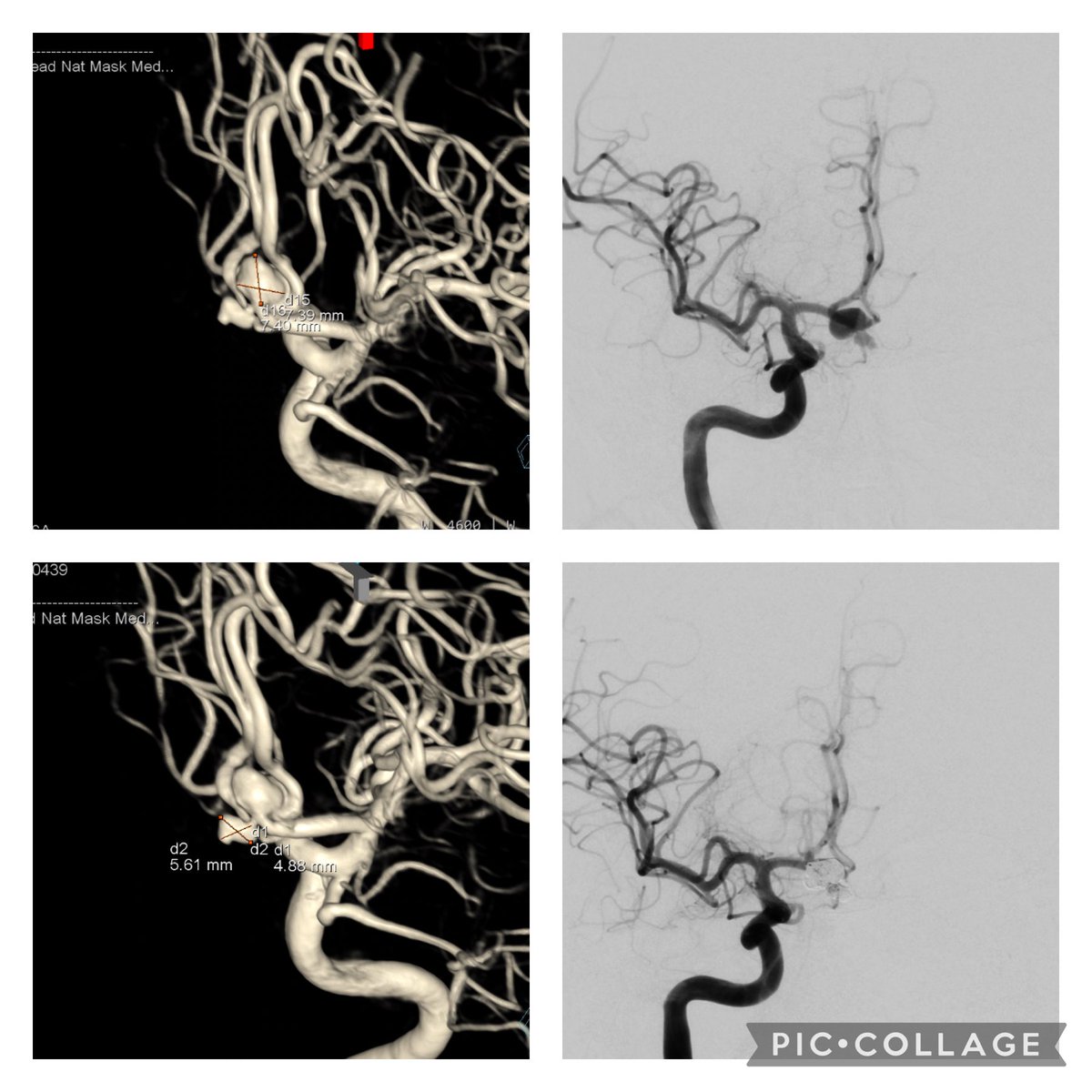RababThamer's tweet photo. Finishing a #cerebrovascular week @THP_hospital with stent assisted coiling of 2 ACOM aneurysms and MCA aneurysm clipping. @cvsection @svinsociety @SNISinfo @BAFOUND    @neurosurgatlas @YoungNIR @youngneuros https://t.co/CnJUzLGrVq
