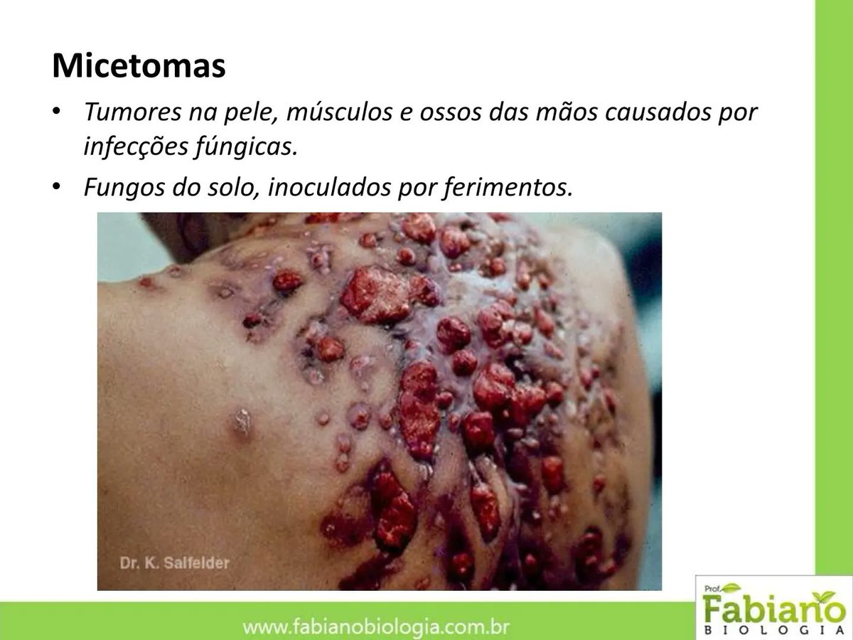 Micetoma é uma infecção crônica e progressiva que afeta a pele subcutânea,  podendo surgir nos pés, membros superiores ou costas. É causada pela  entrada de fungos no corpo humano através de uma, image size:1200x900