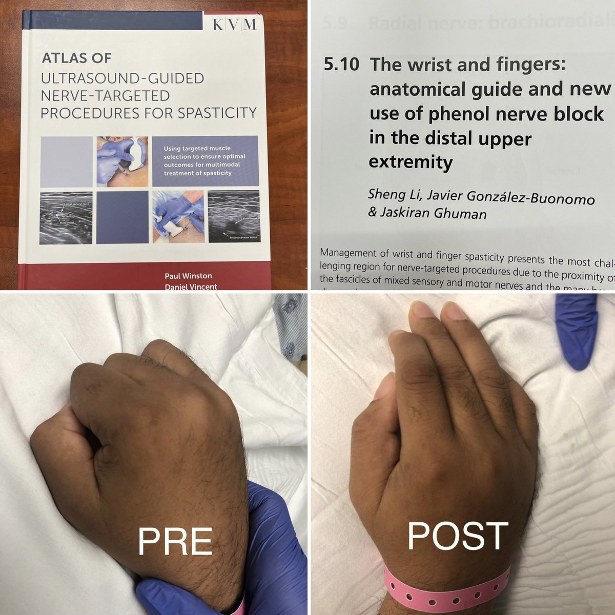 Glad to contribute to this must-have reference book for nerve blocks for #spasticity mgmt with talented former #BIM fellows <a href="/GonzalezBuonomo/">Javier González-Buonomo</a> and Dr Ghuman! A case of median nerve motor branch #phenol before they graduated! #physiatry