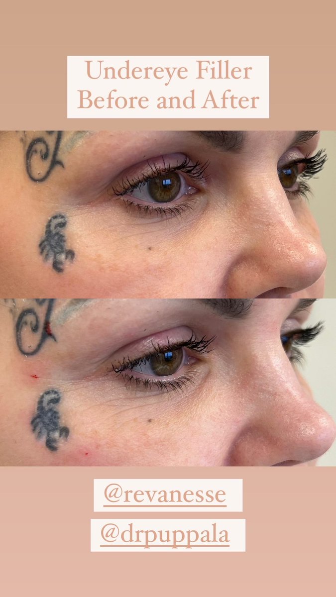 healthparkbotox's tweet image. Under Eye Filler for dark circles #undereye #darkcircles #Filler @healthparkbotox